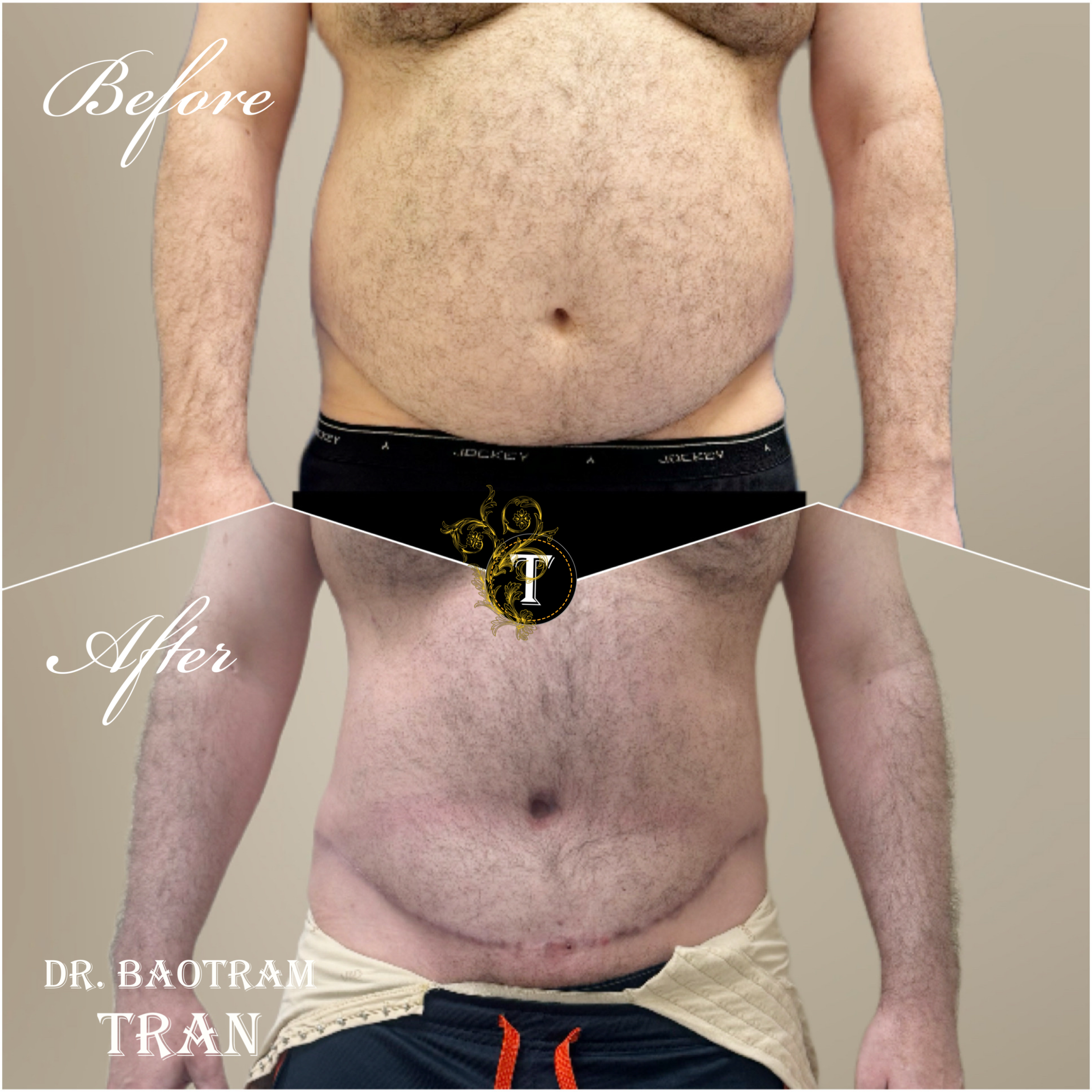 Before and After Image: Male Tummy Tuck - front