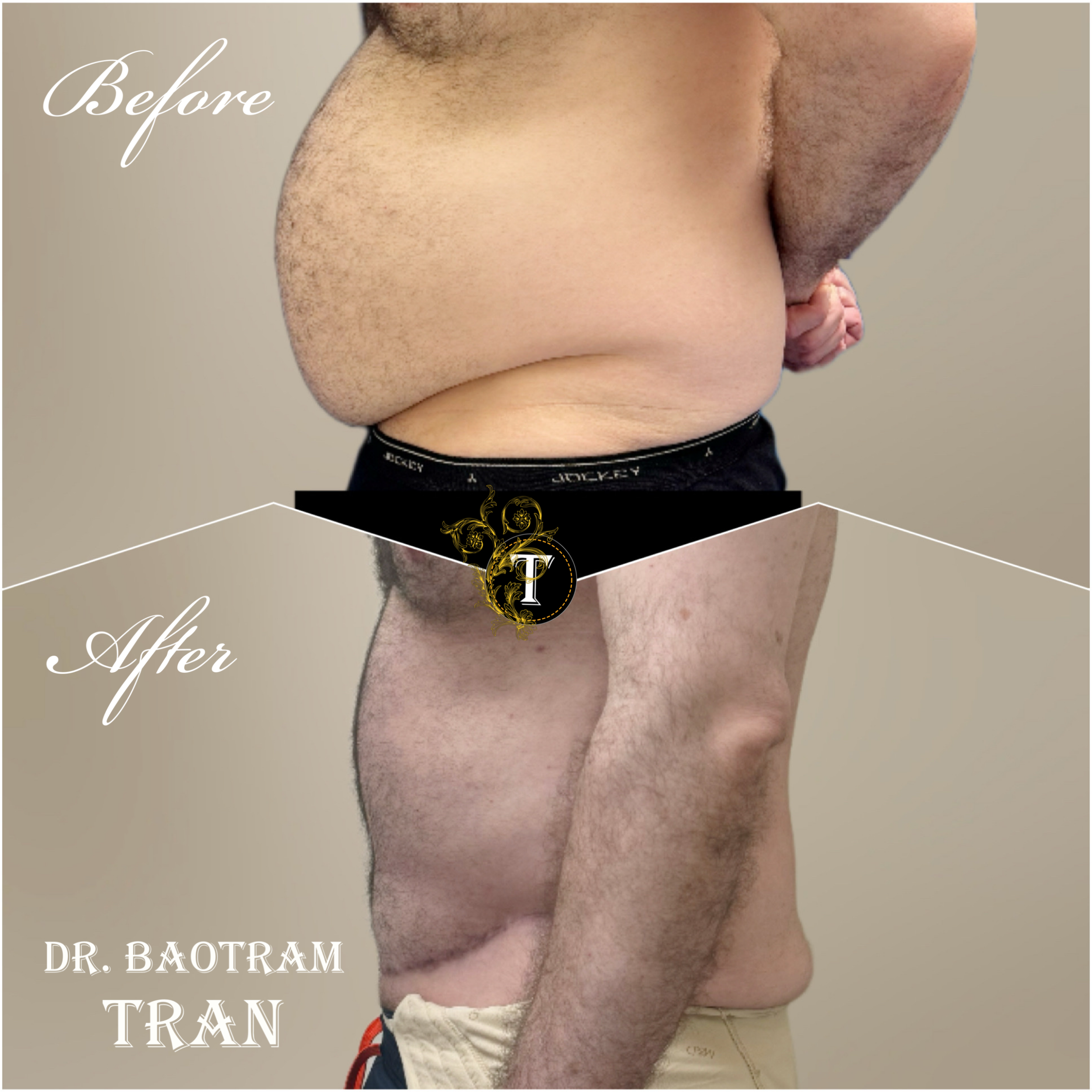 Before and After Image: Male Tummy Tuck - left-side