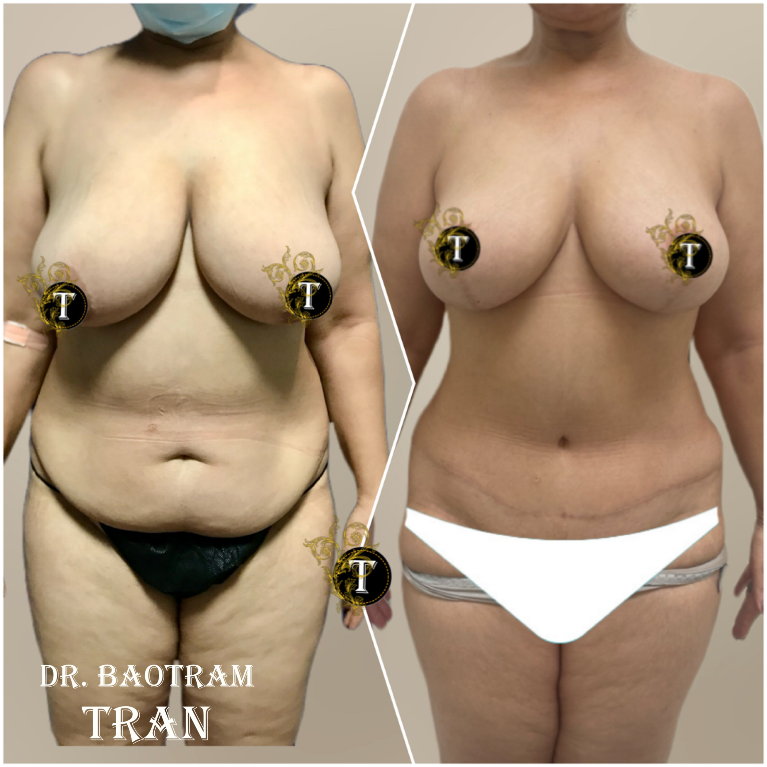 Before and After Image: Mommy Makeover - front