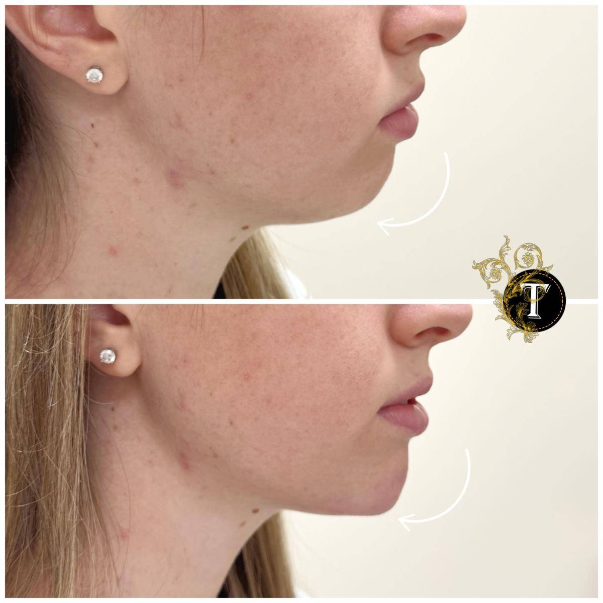 Before and After Image: Non-Surgical Procedure - right-side