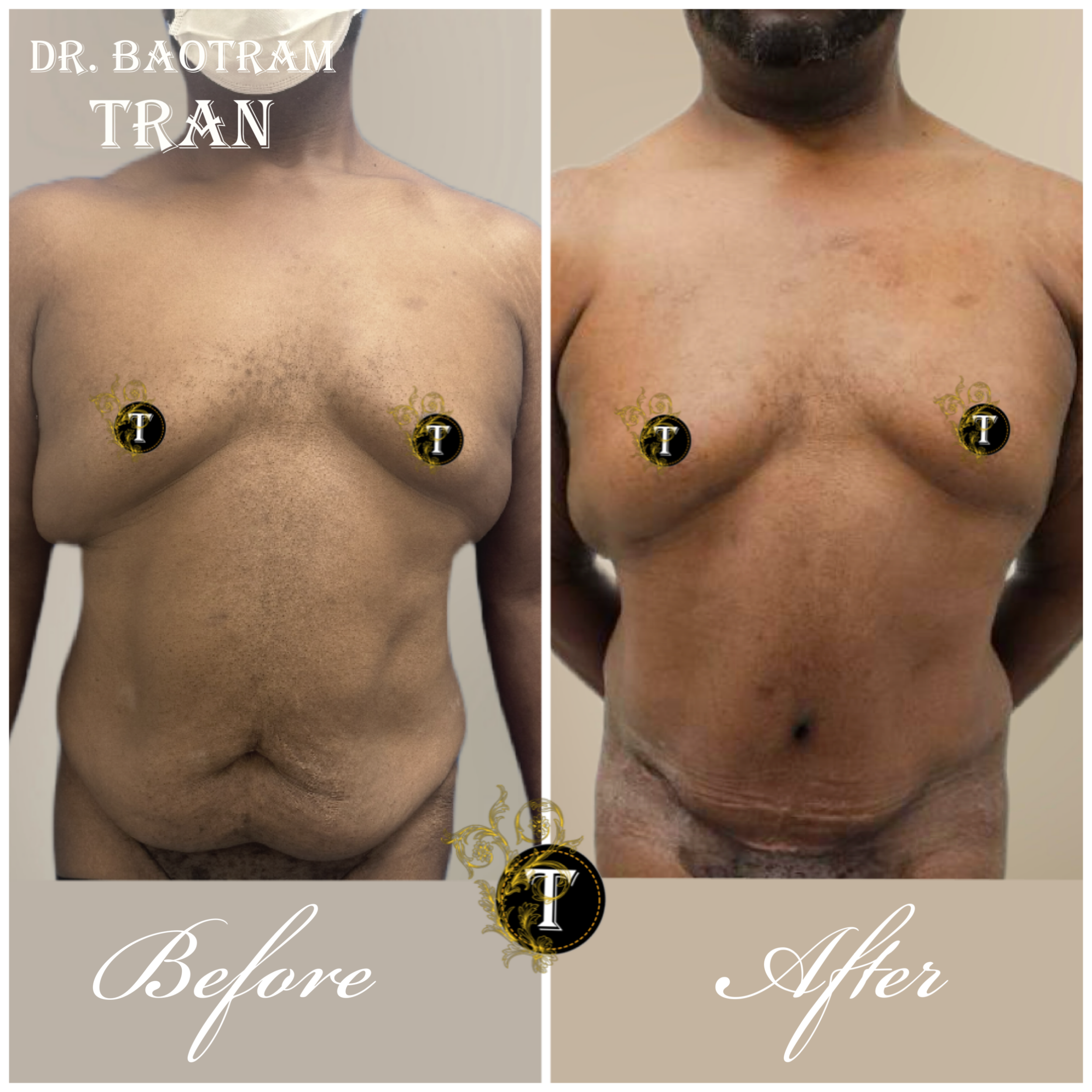 Before and After Image: Male Tummy Tuck - front