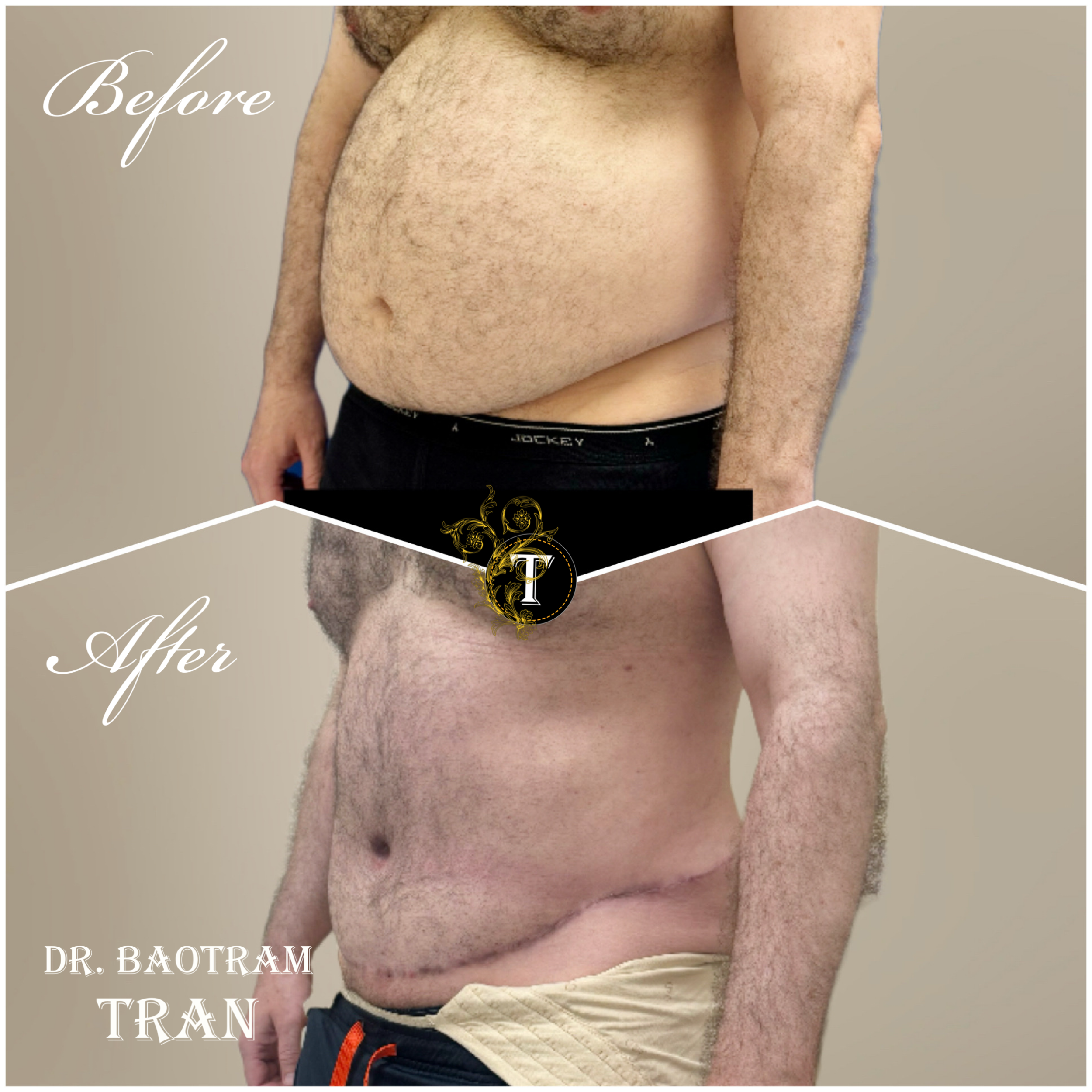 Before and After Image: Male Tummy Tuck - left-front-oblique