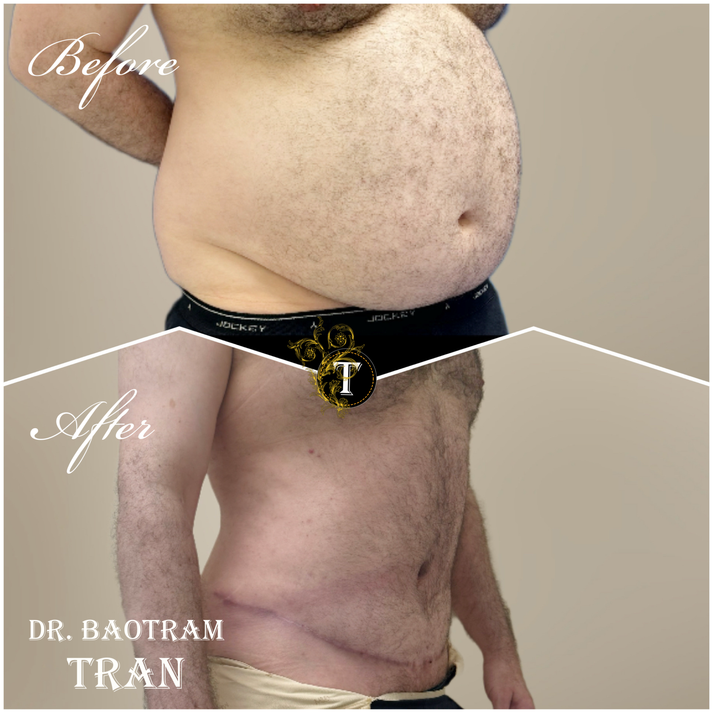 Before and After Image: Male Tummy Tuck - right-front-oblique
