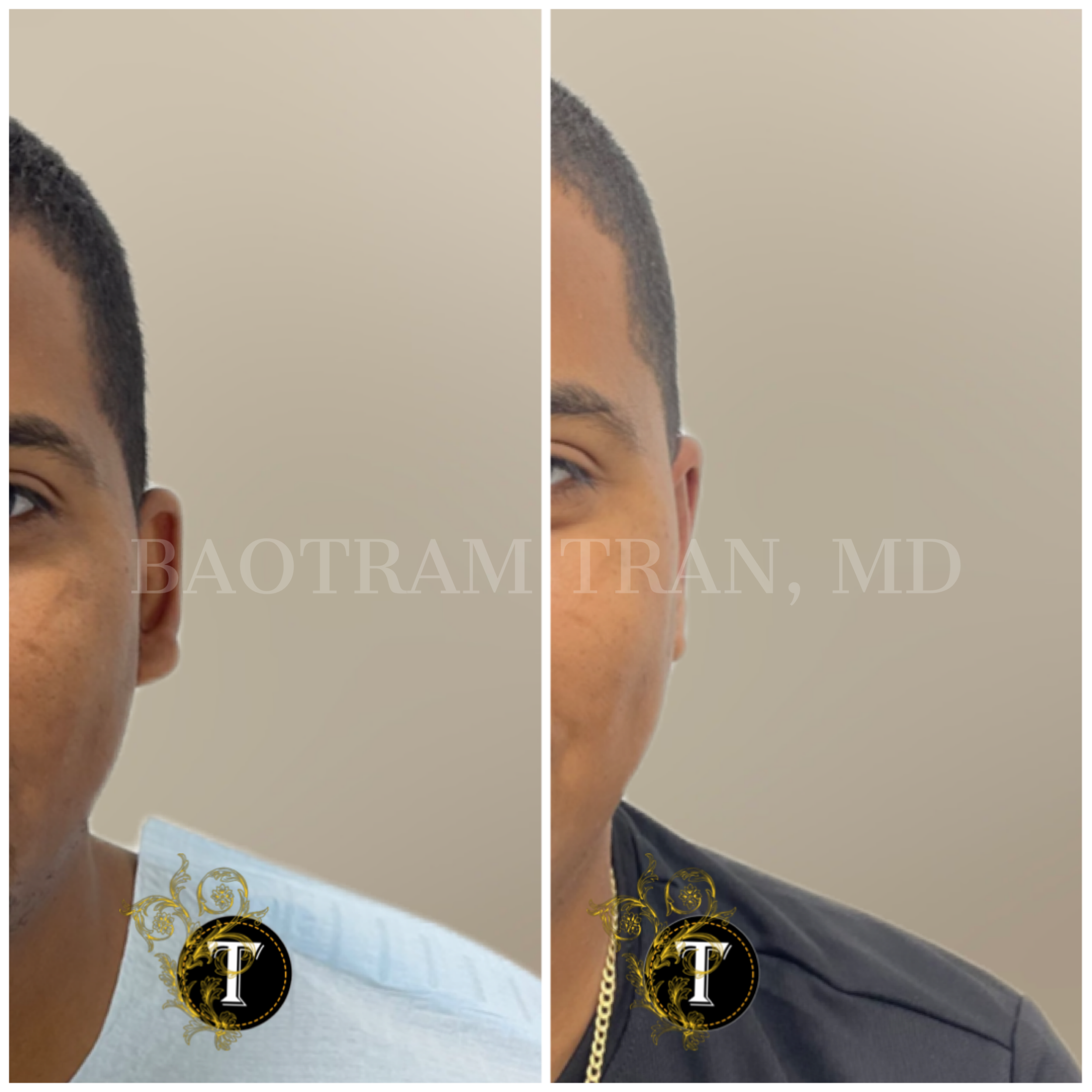 Before and After Image: Otoplasty (Ear pinning) - front