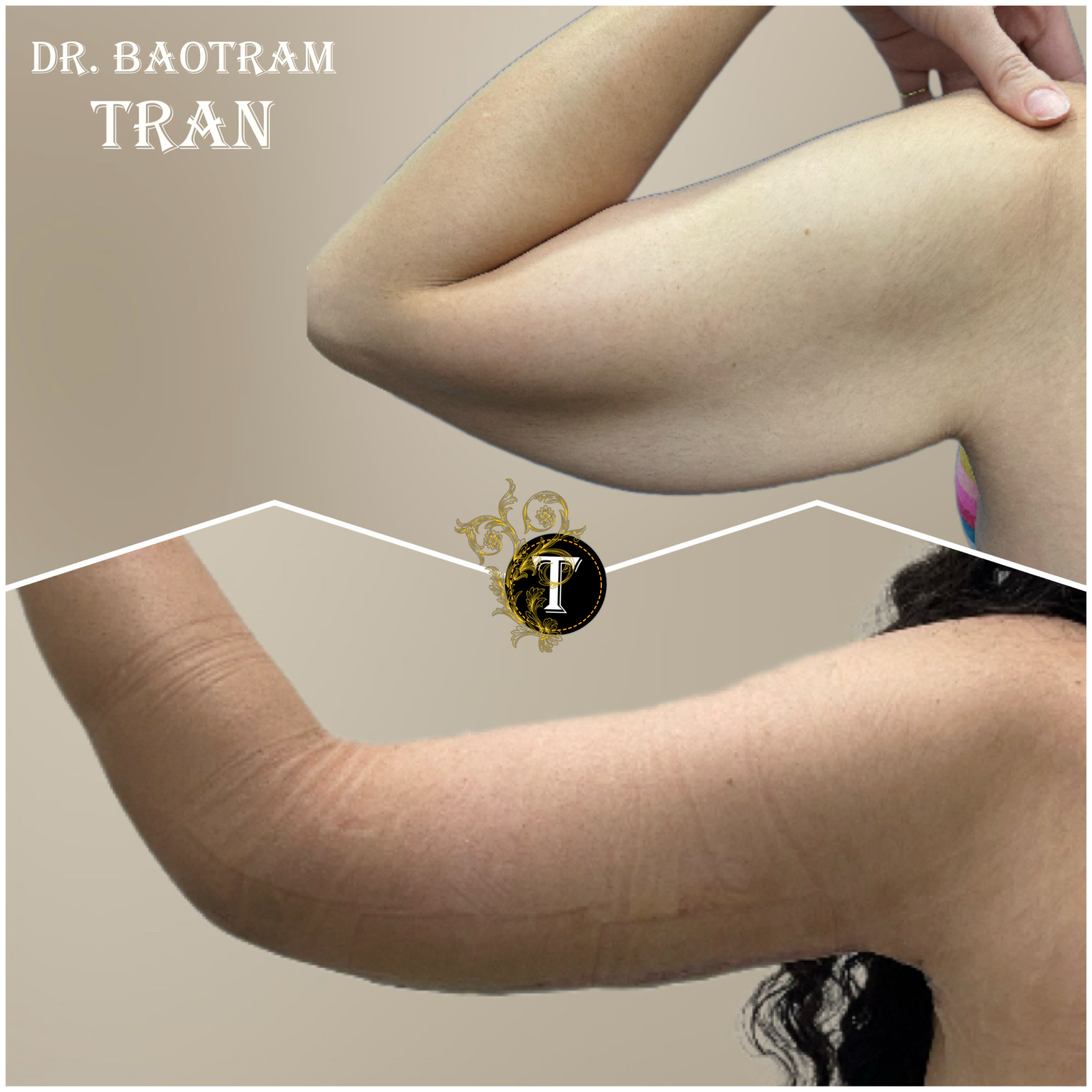 Before and After Image: Arm Lift - back