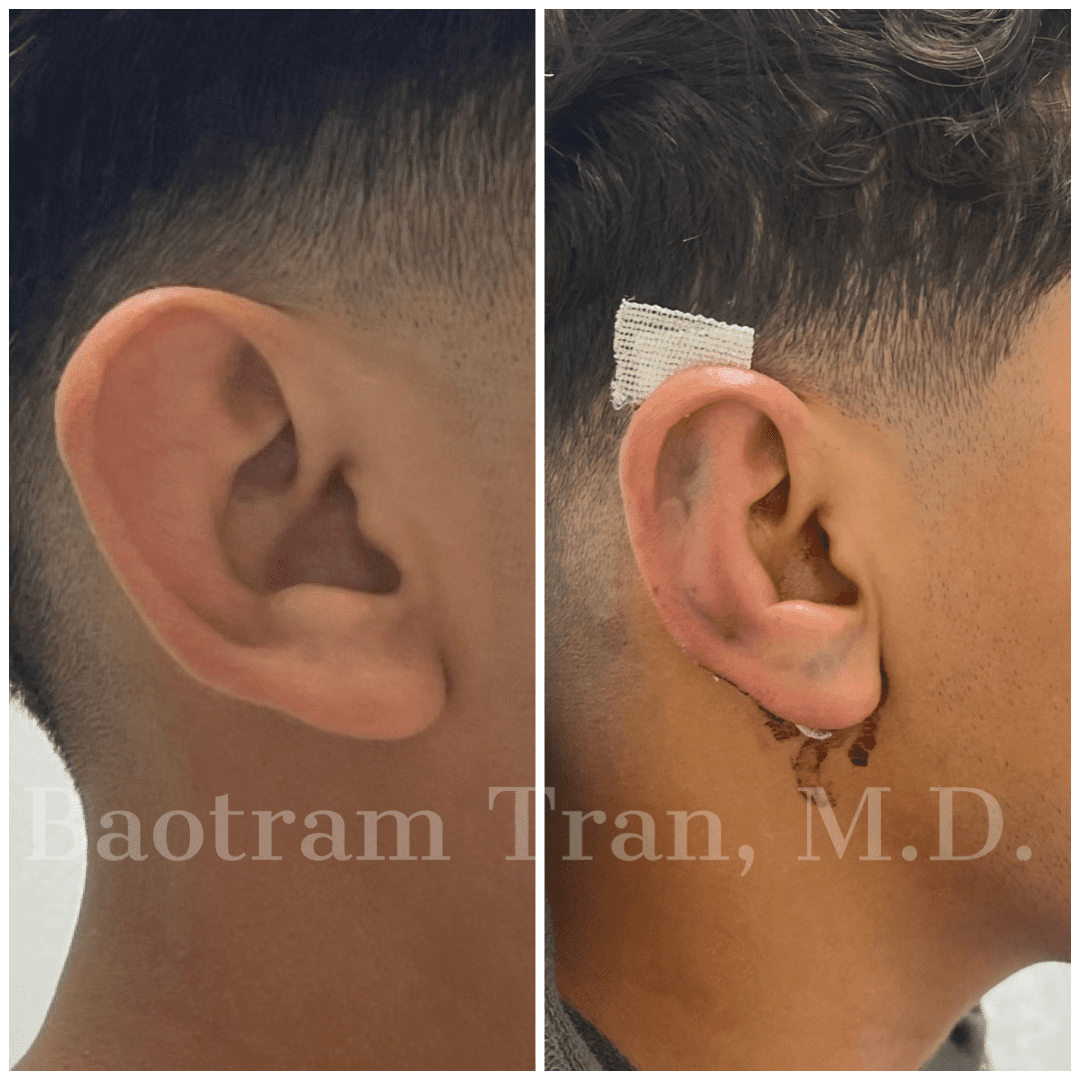 Before and After Image: Otoplasty (Ear pinning) - right-side