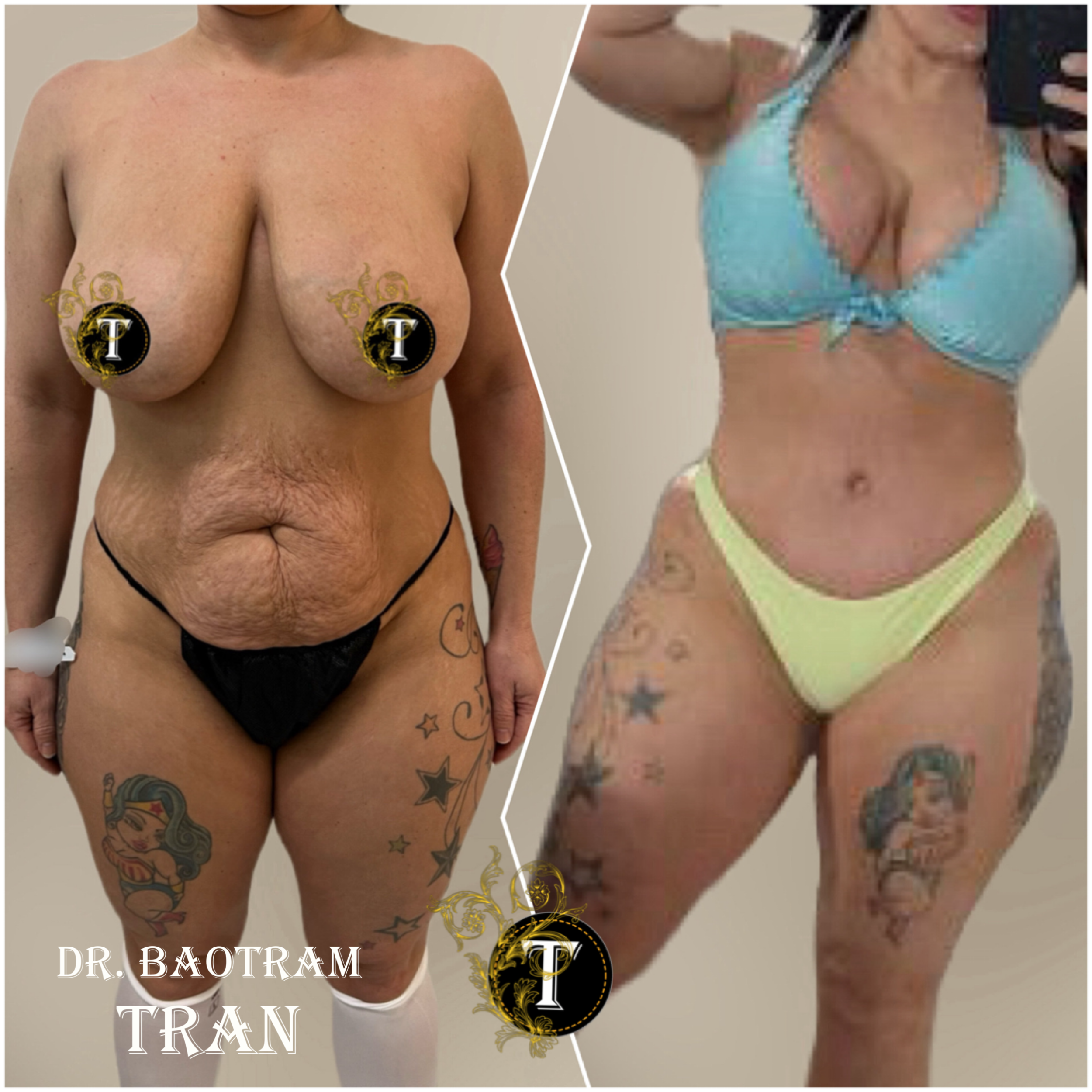 Before and After Image: Mommy Makeover - front