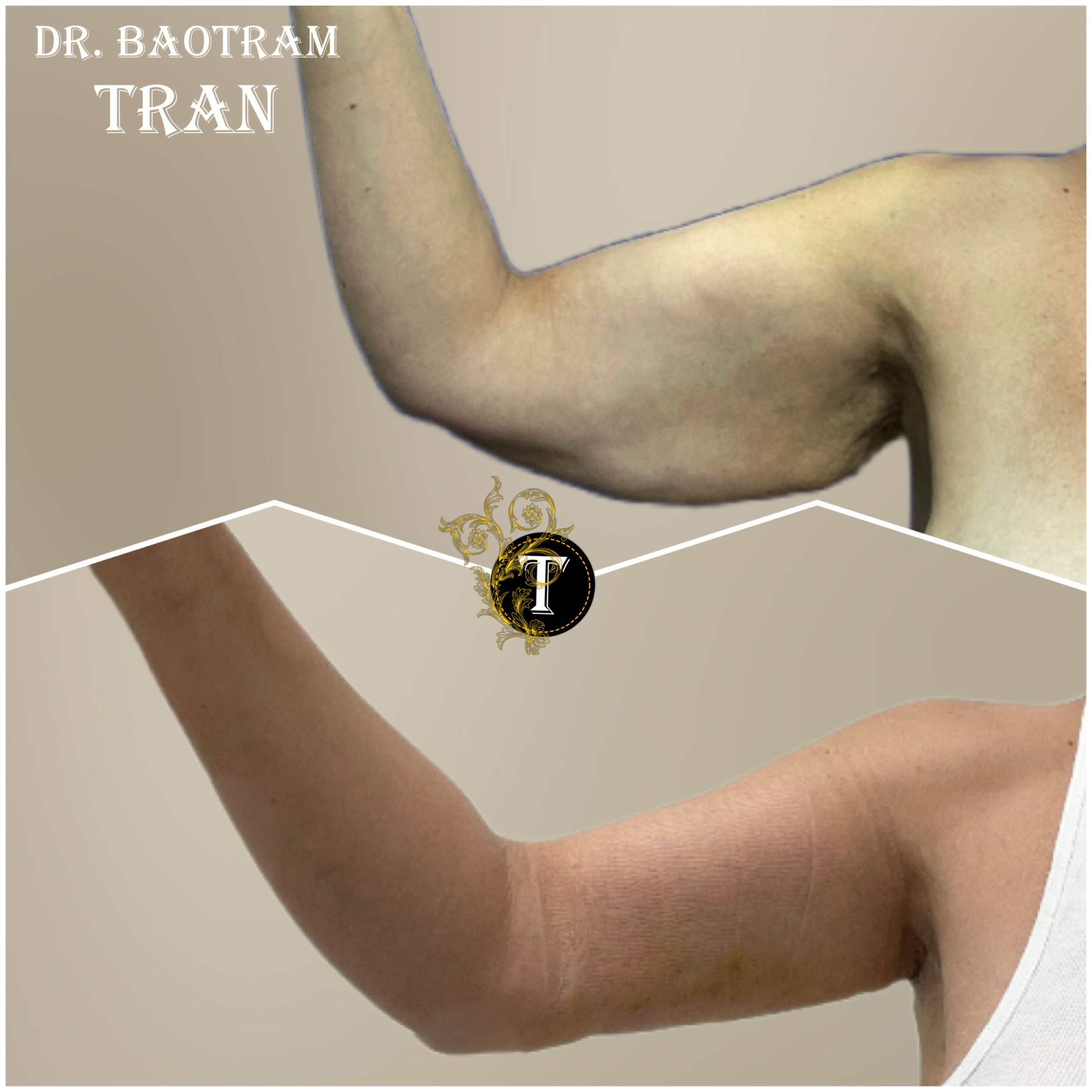 Before and After Image: Arm Lift - front