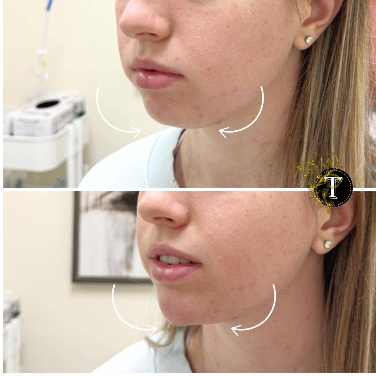 Before and After Image: Non-Surgical Procedure - left-front-oblique