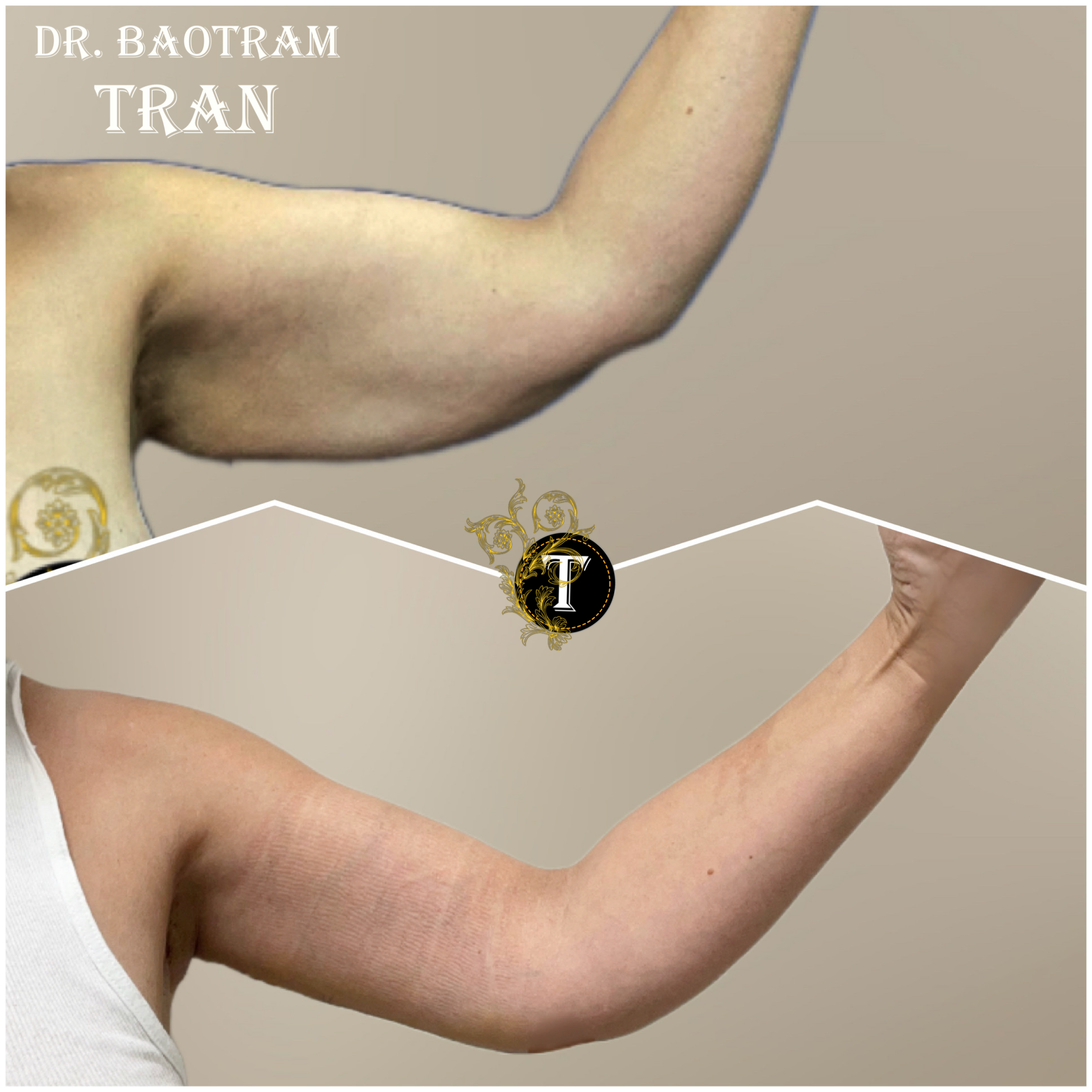 Before and After Image: Arm Lift - front