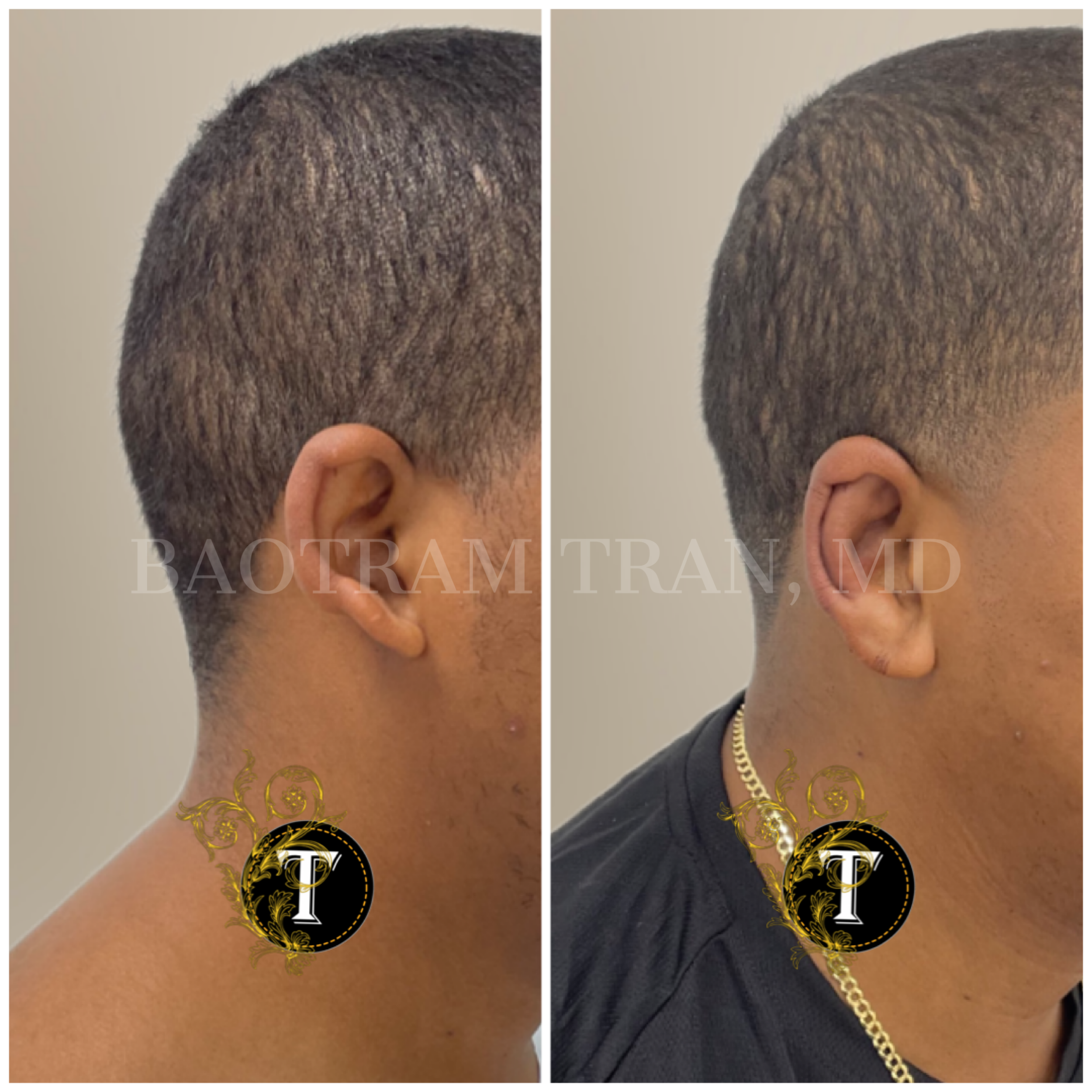 Before and After Image: Otoplasty (Ear pinning) - right-side