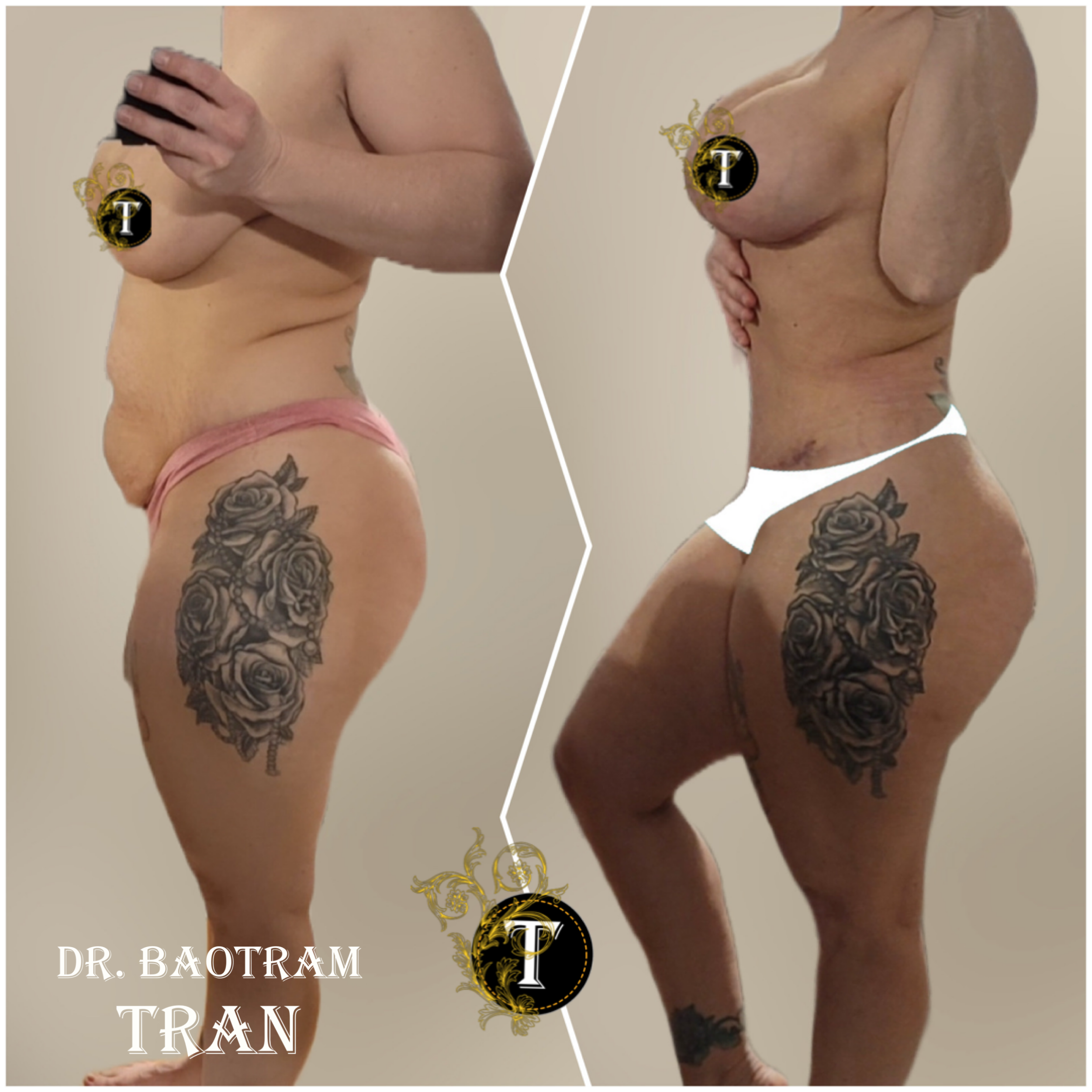 Before and After Image: Mommy Makeover - left-side