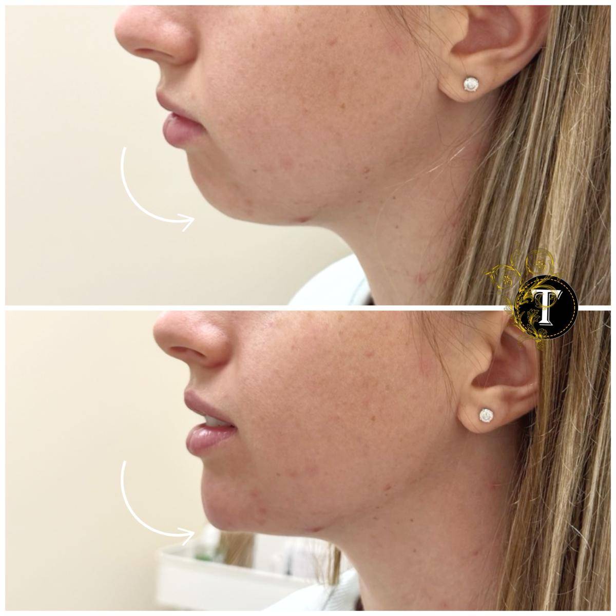 Before and After Image: Non-Surgical Procedure - left-side