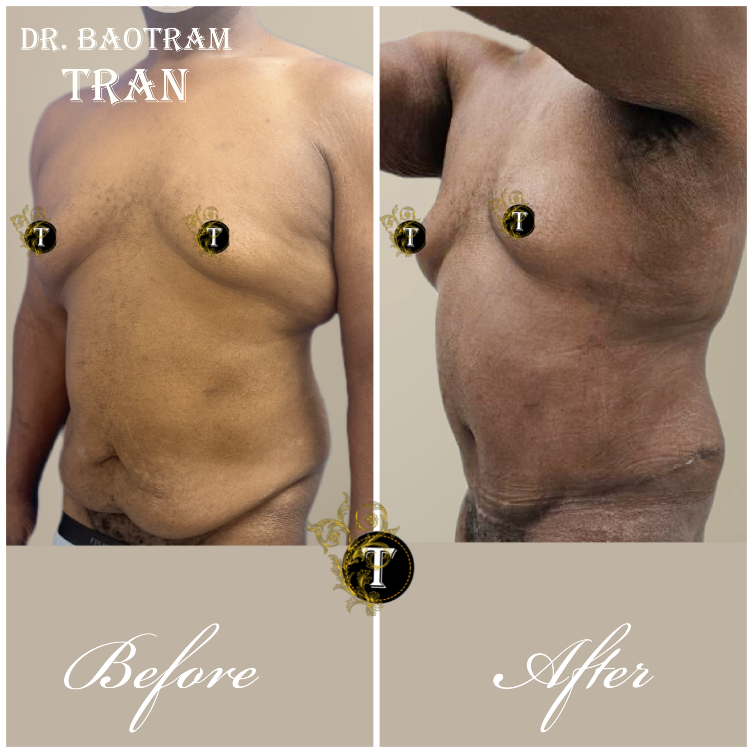 Before and After Image: Male Tummy Tuck - left-front-oblique