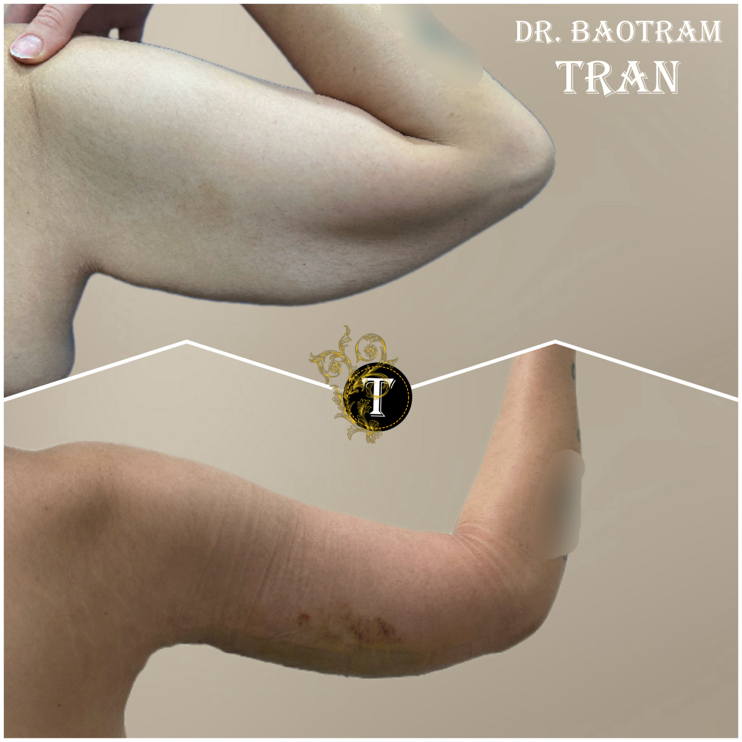 Before and After Image: Arm Lift - back