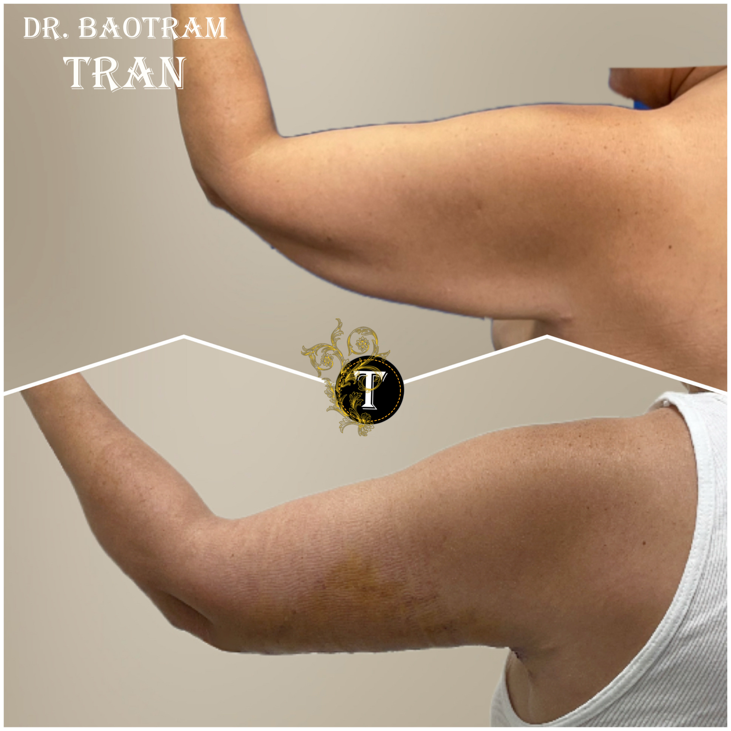 Before and After Image: Arm Lift - back