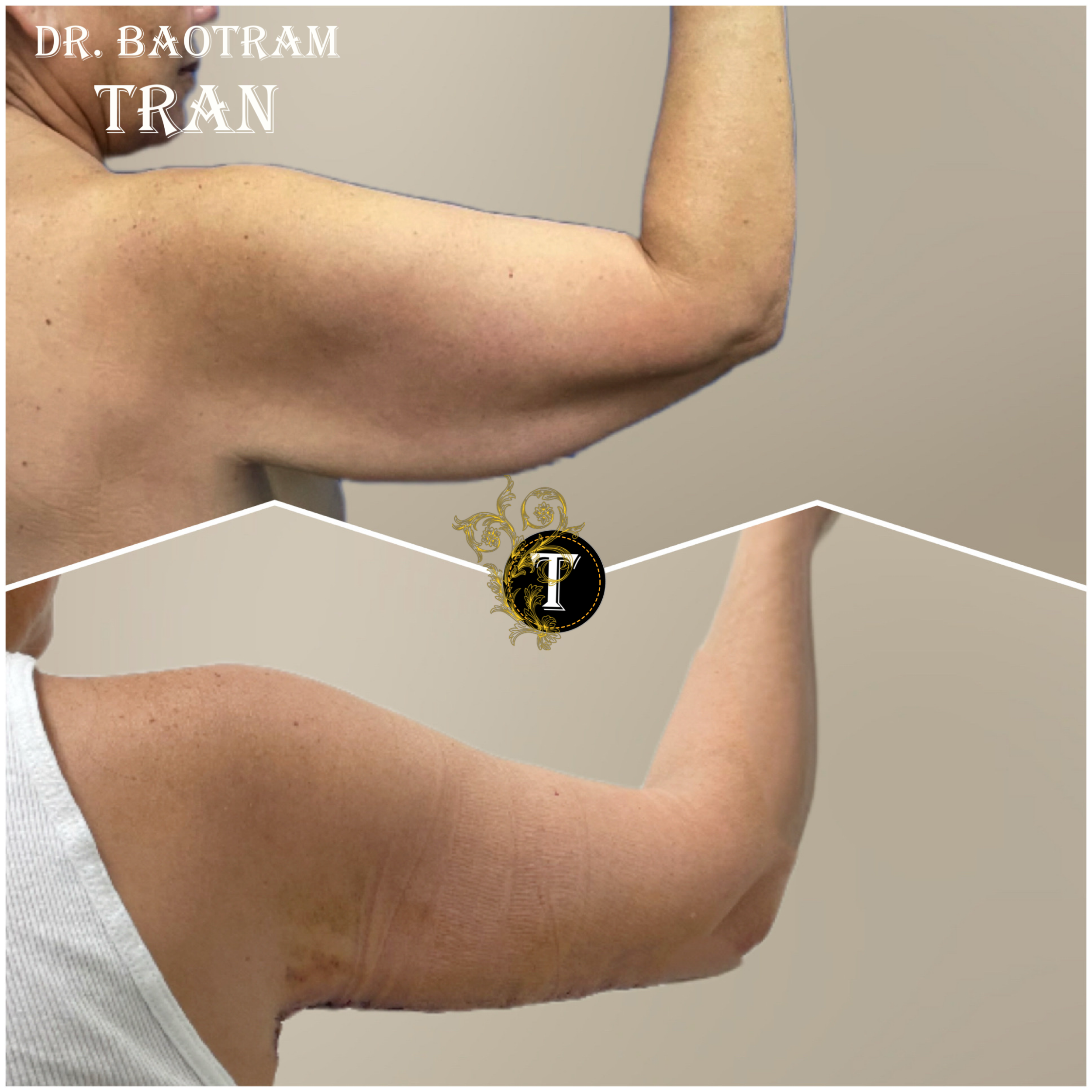 Before and After Image: Arm Lift - back