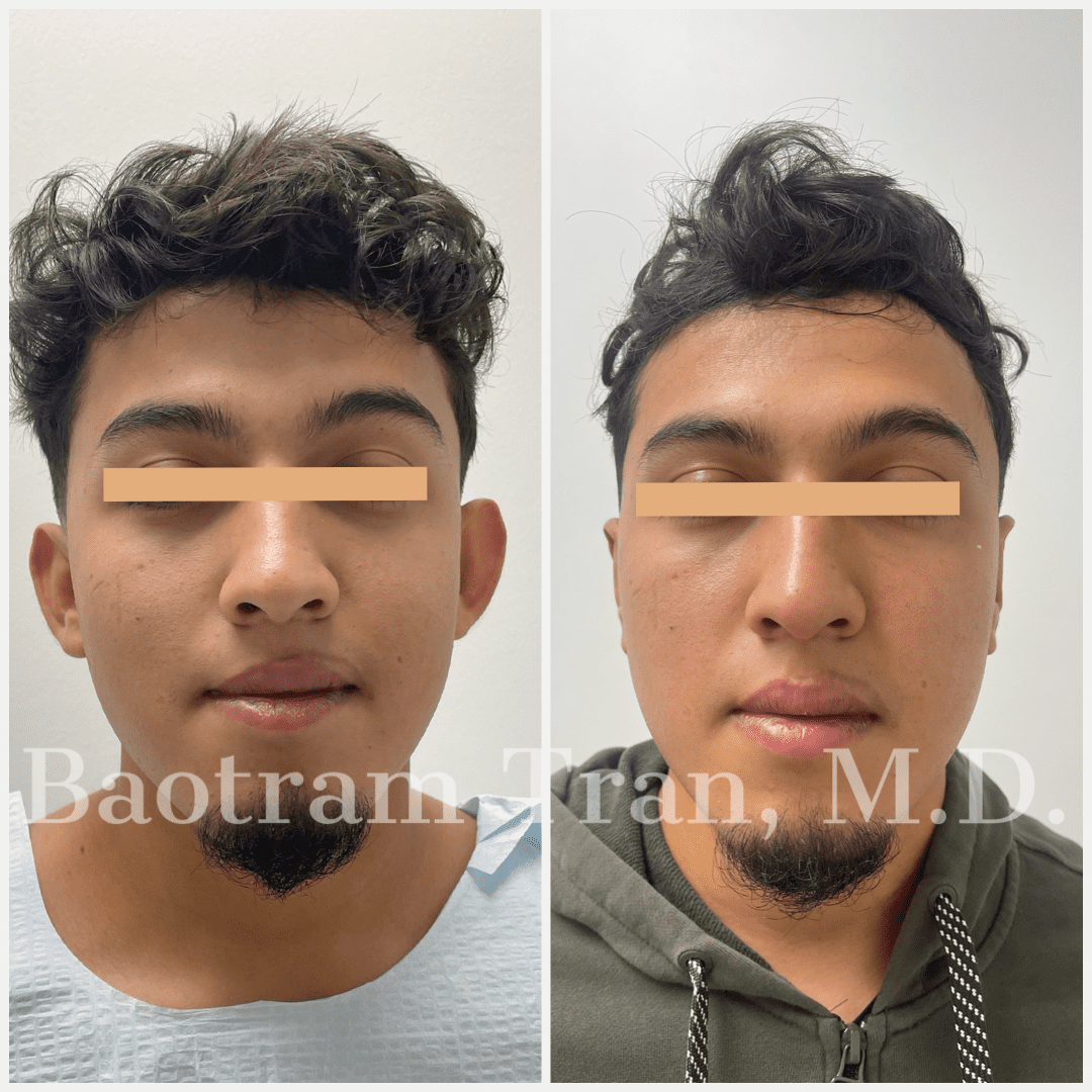 Before and After Image: Otoplasty (Ear pinning) - front