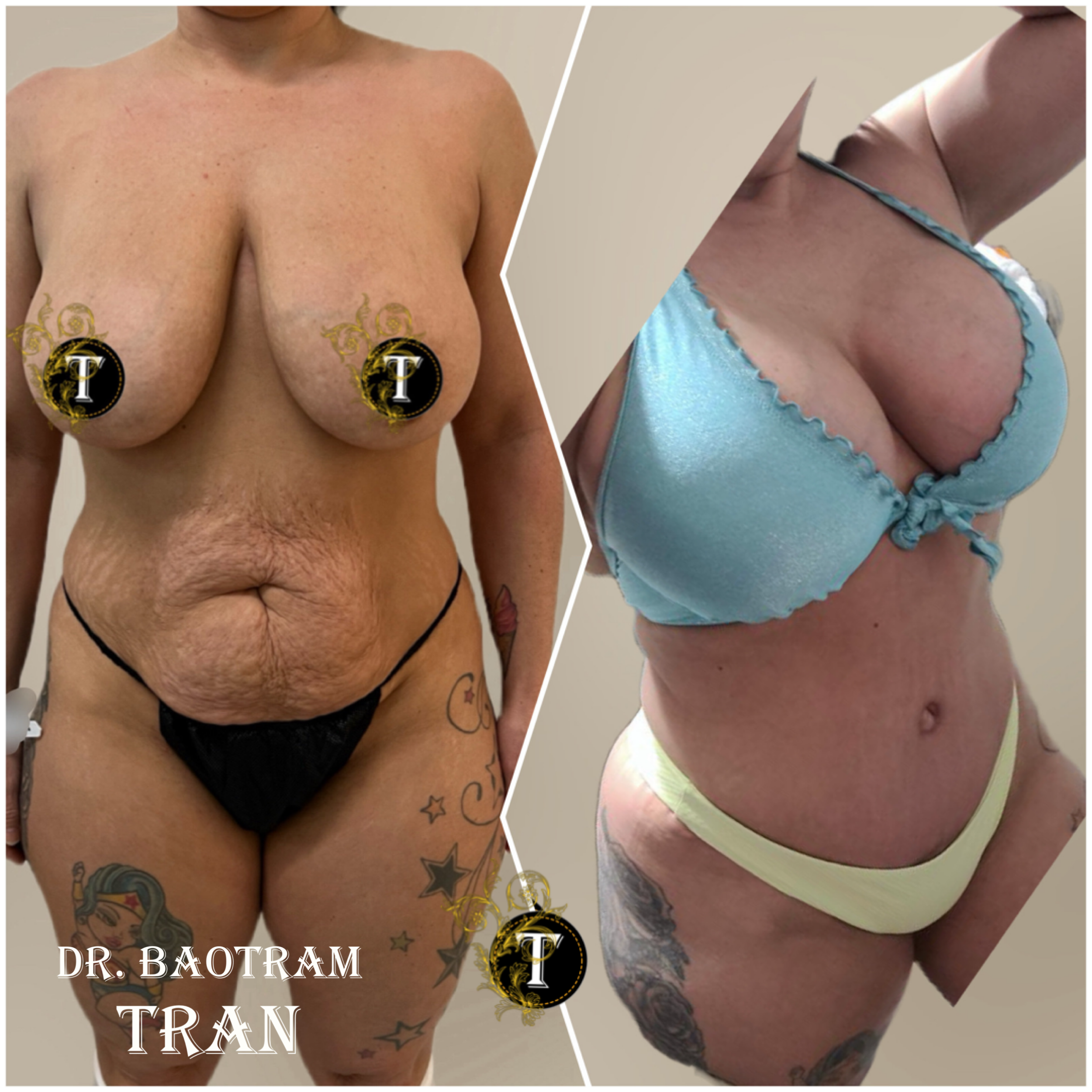 Before and After Image: Mommy Makeover - front