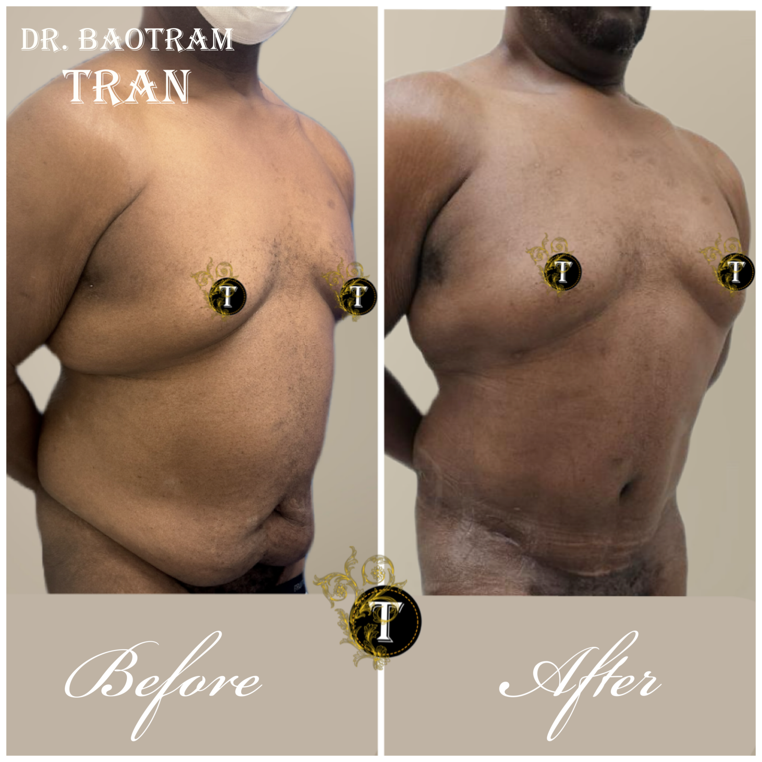 Before and After Image: Male Tummy Tuck - right-front-oblique