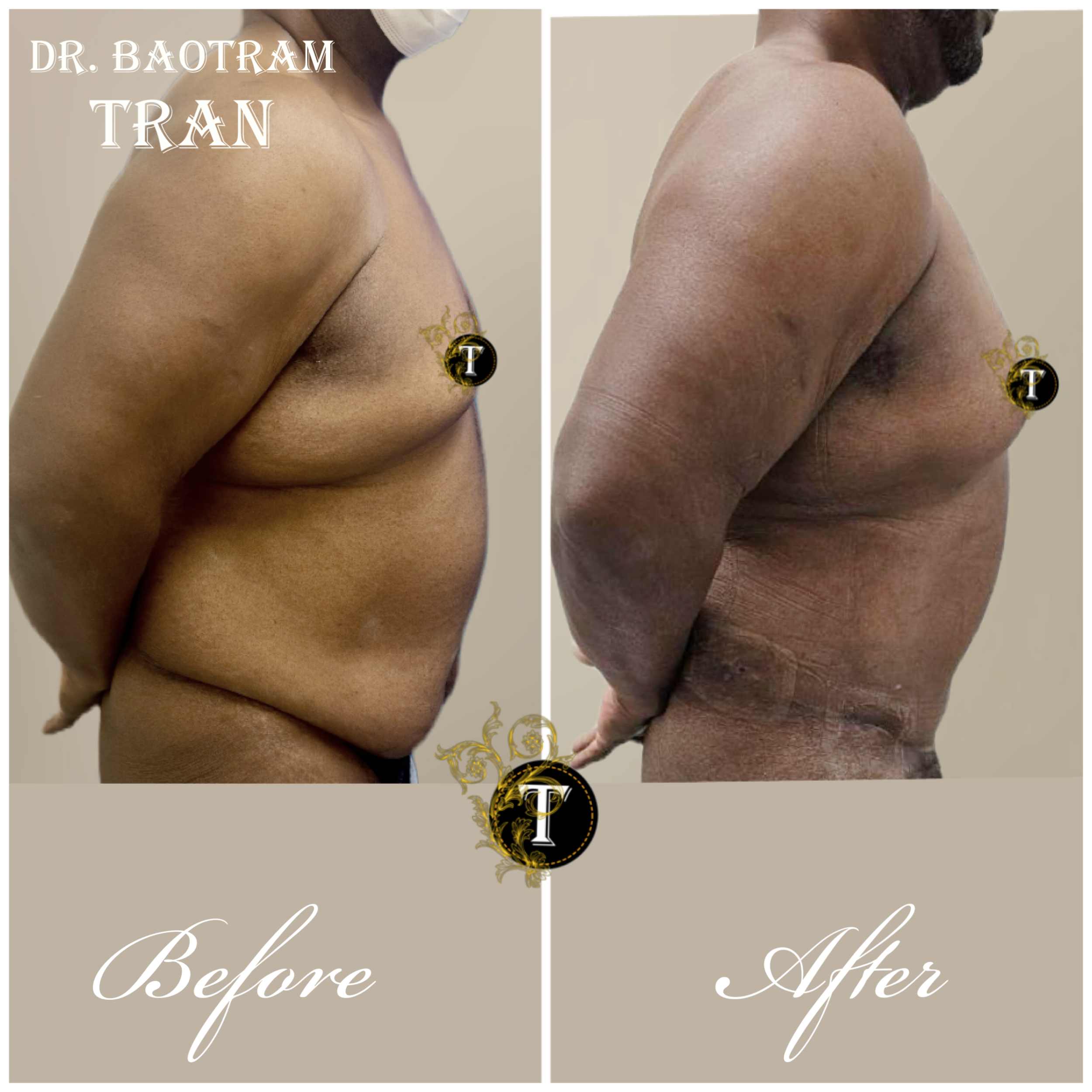Before and After Image: Male Tummy Tuck - right-side
