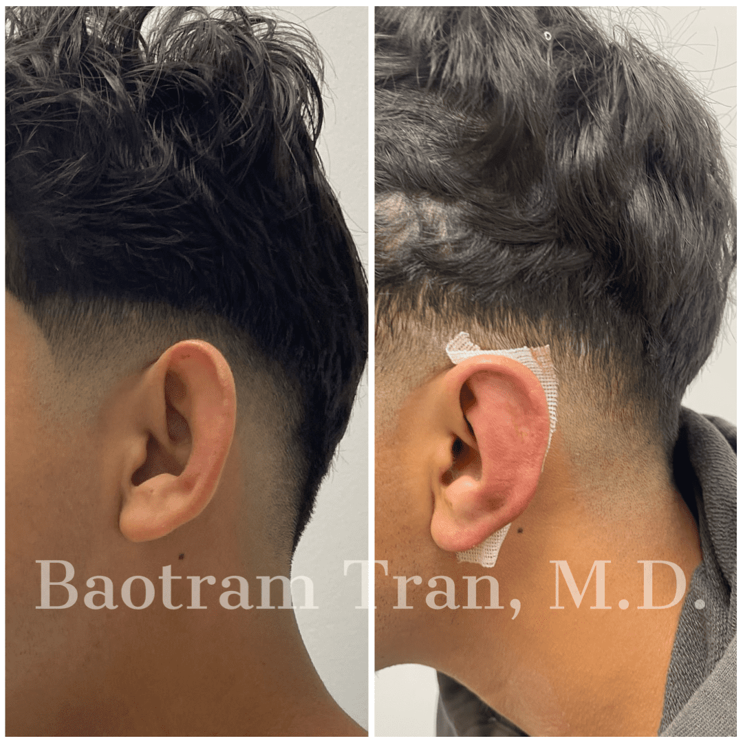 Before and After Image: Otoplasty (Ear pinning) - left-side
