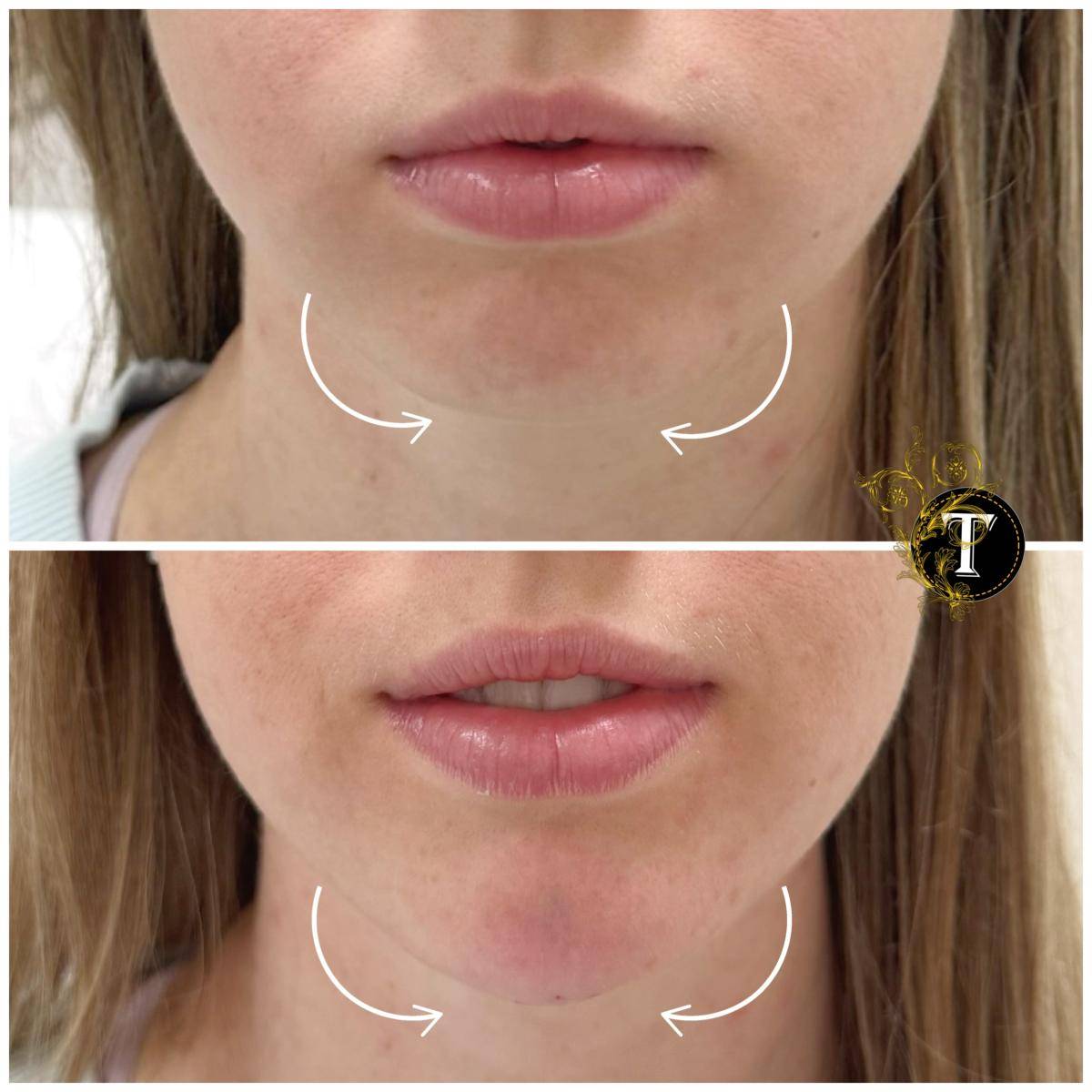 Before and After Image: Non-Surgical Procedure -