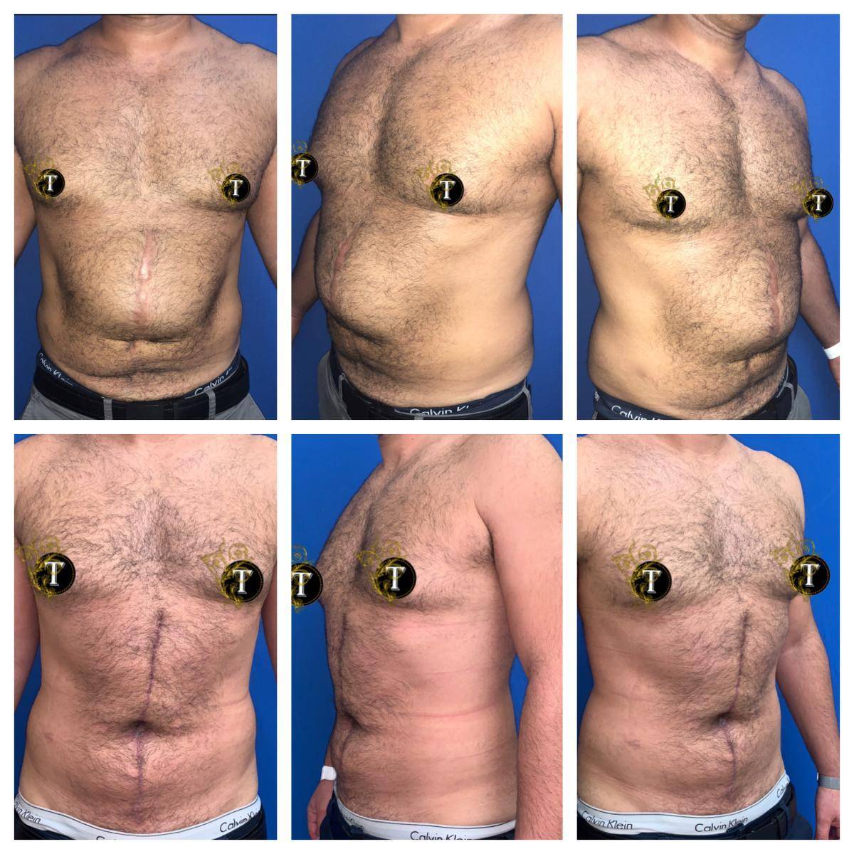 Before and After Image: Male Tummy Tuck - front