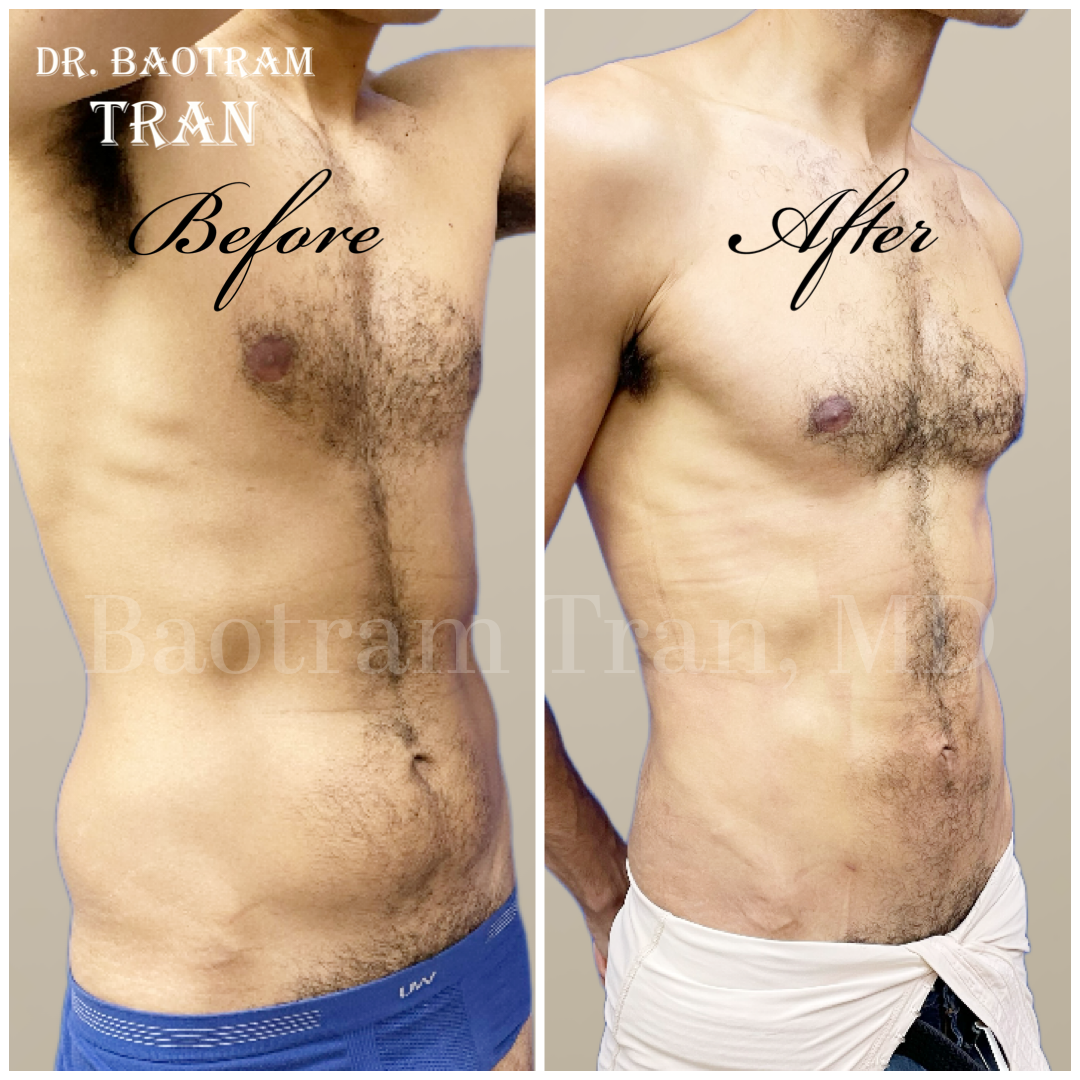 Before and After Image: Male Liposuction - right-front-oblique