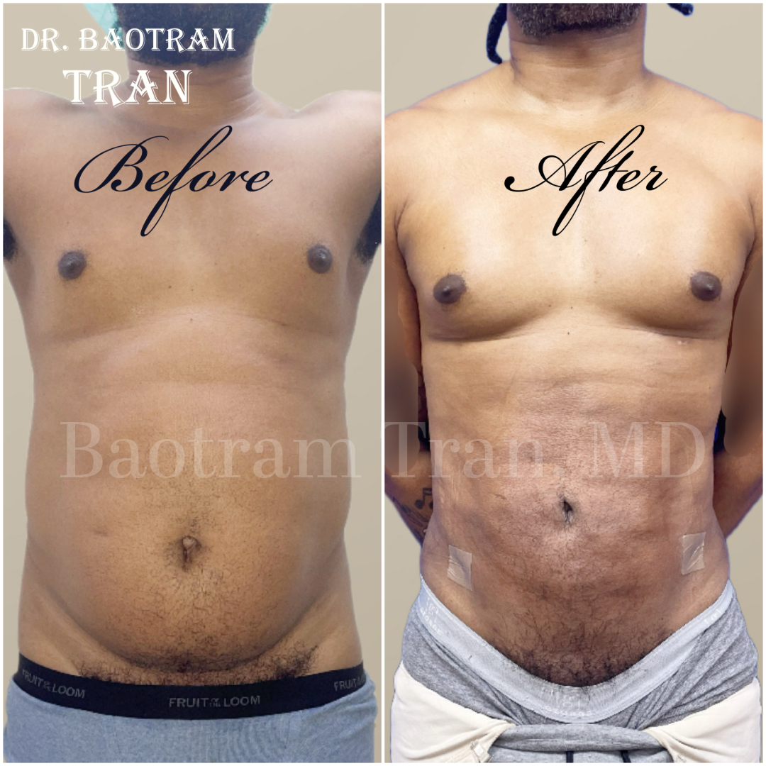Before and After Image: Male Liposuction - front