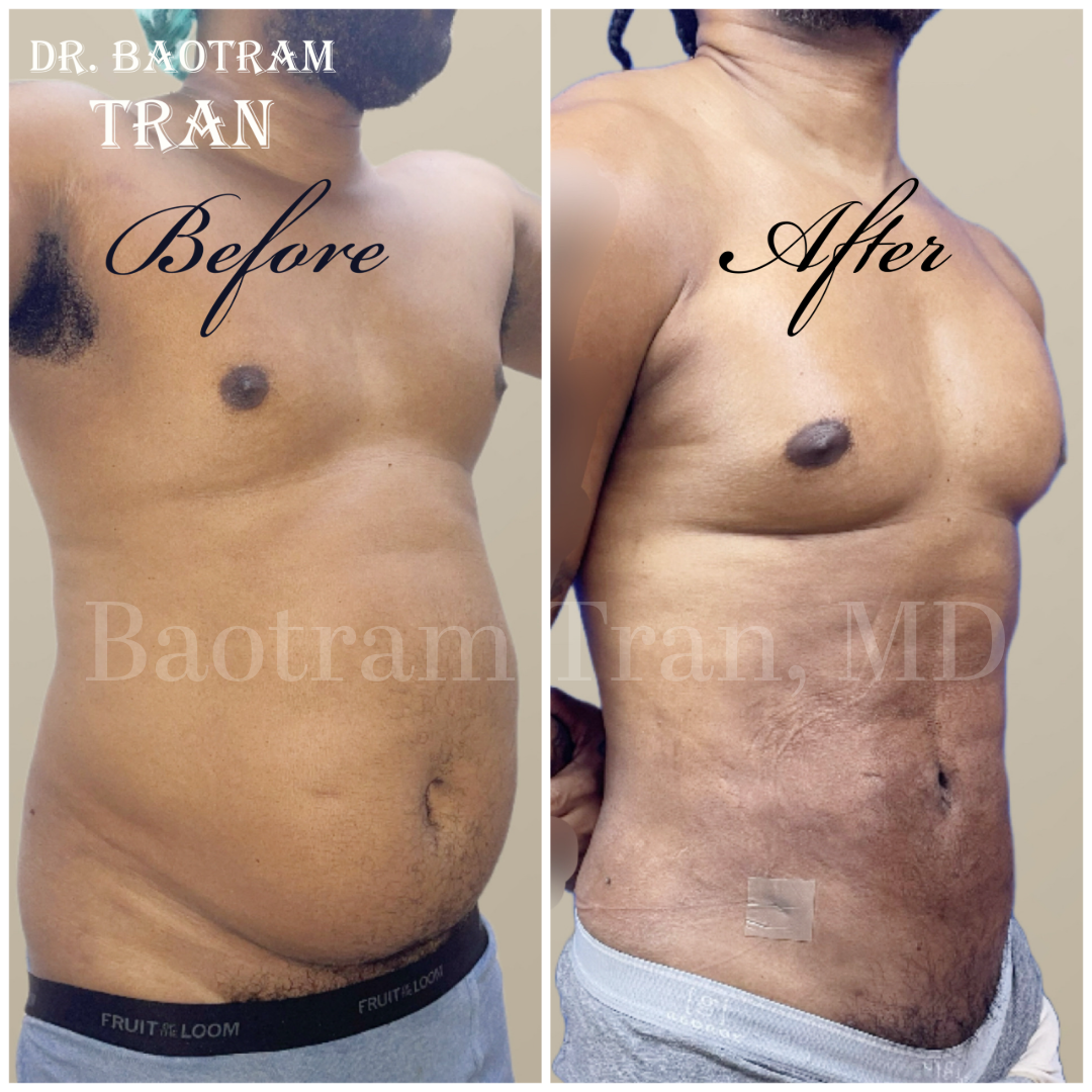 Before and After Image: Male Liposuction - right-front-oblique