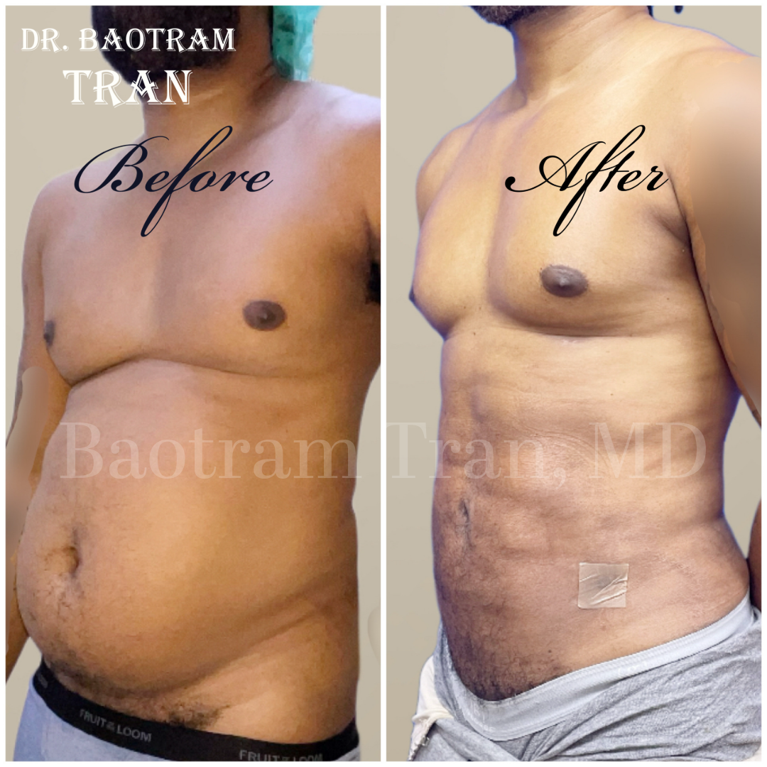 Before and After Image: Male Liposuction - left-front-oblique
