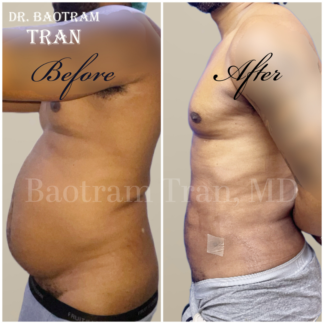 Before and After Image: Male Liposuction - left-side