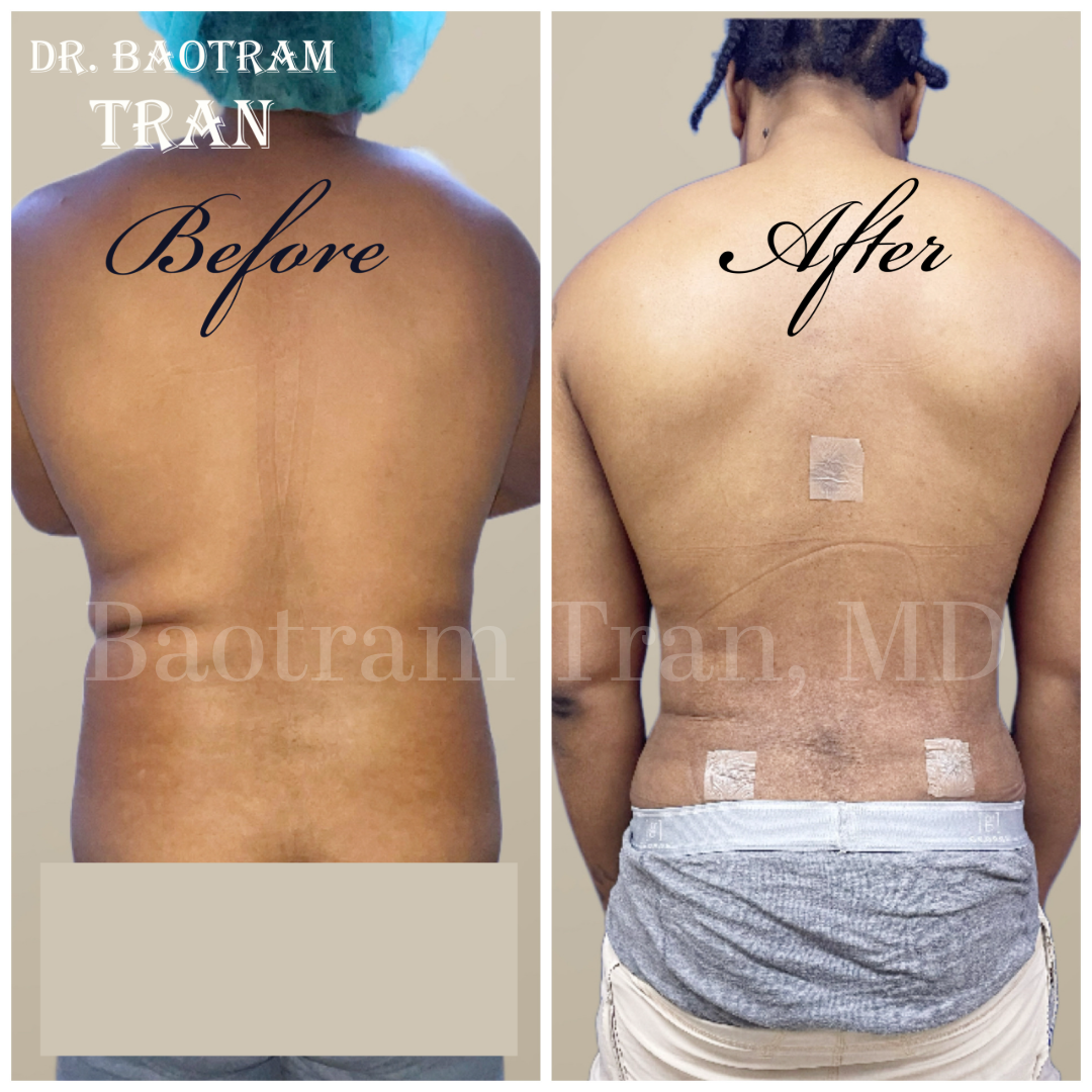 Before and After Image: Male Liposuction - back