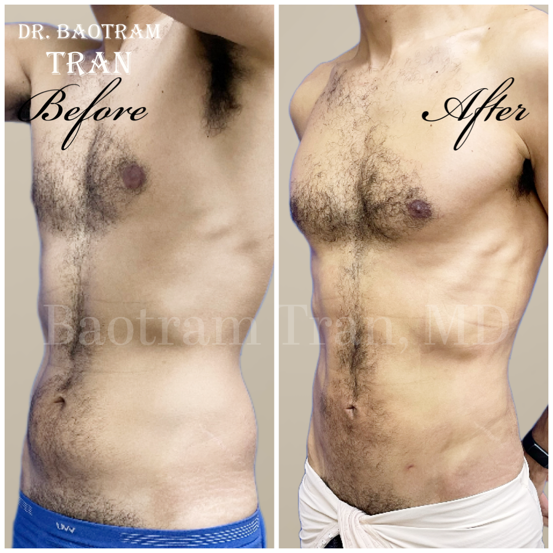 Before and After Image: Male Liposuction - left-front-oblique