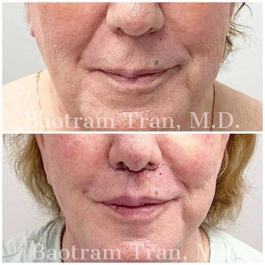 Before and After Image: Lip Lift - front