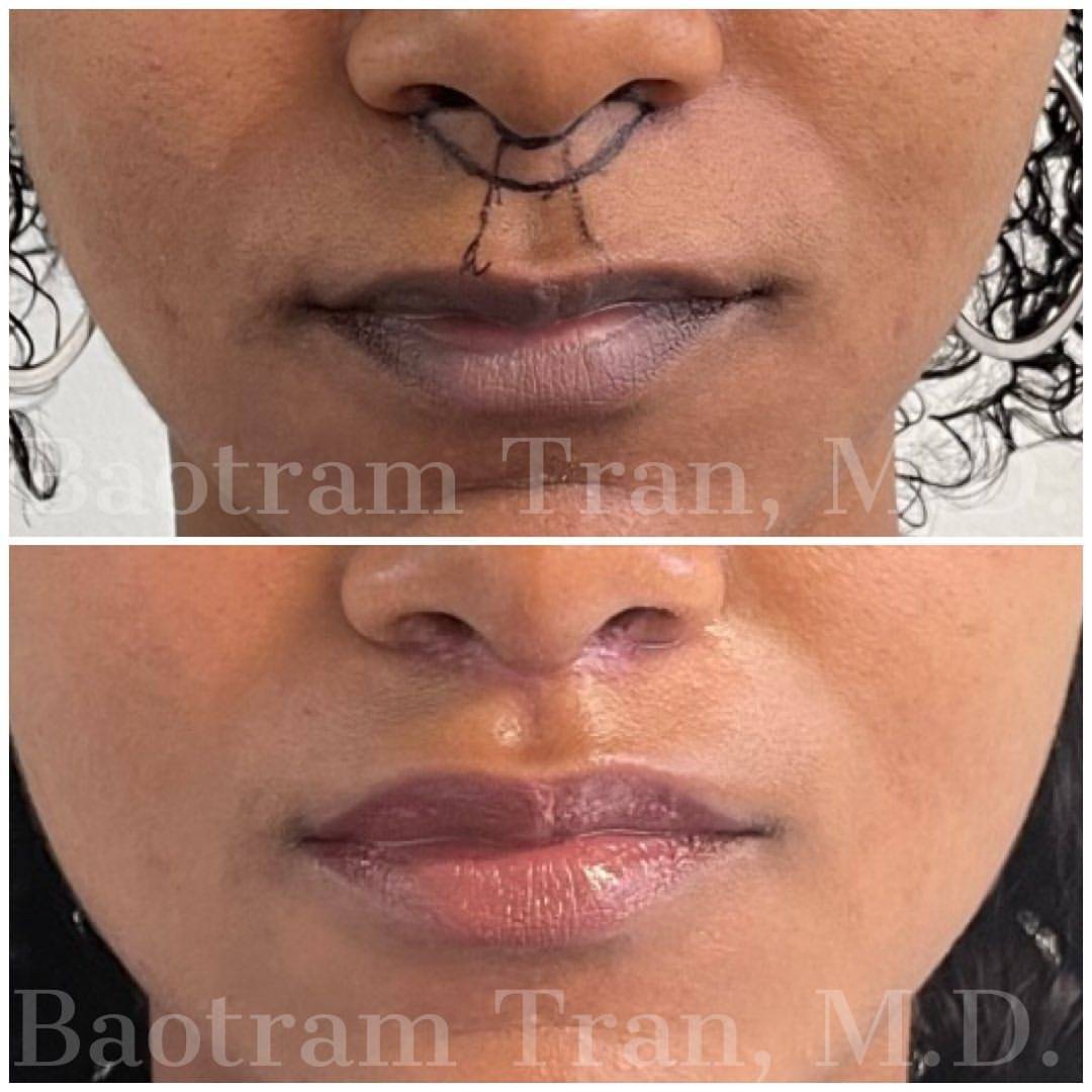 Before and After Image: Lip Lift - front