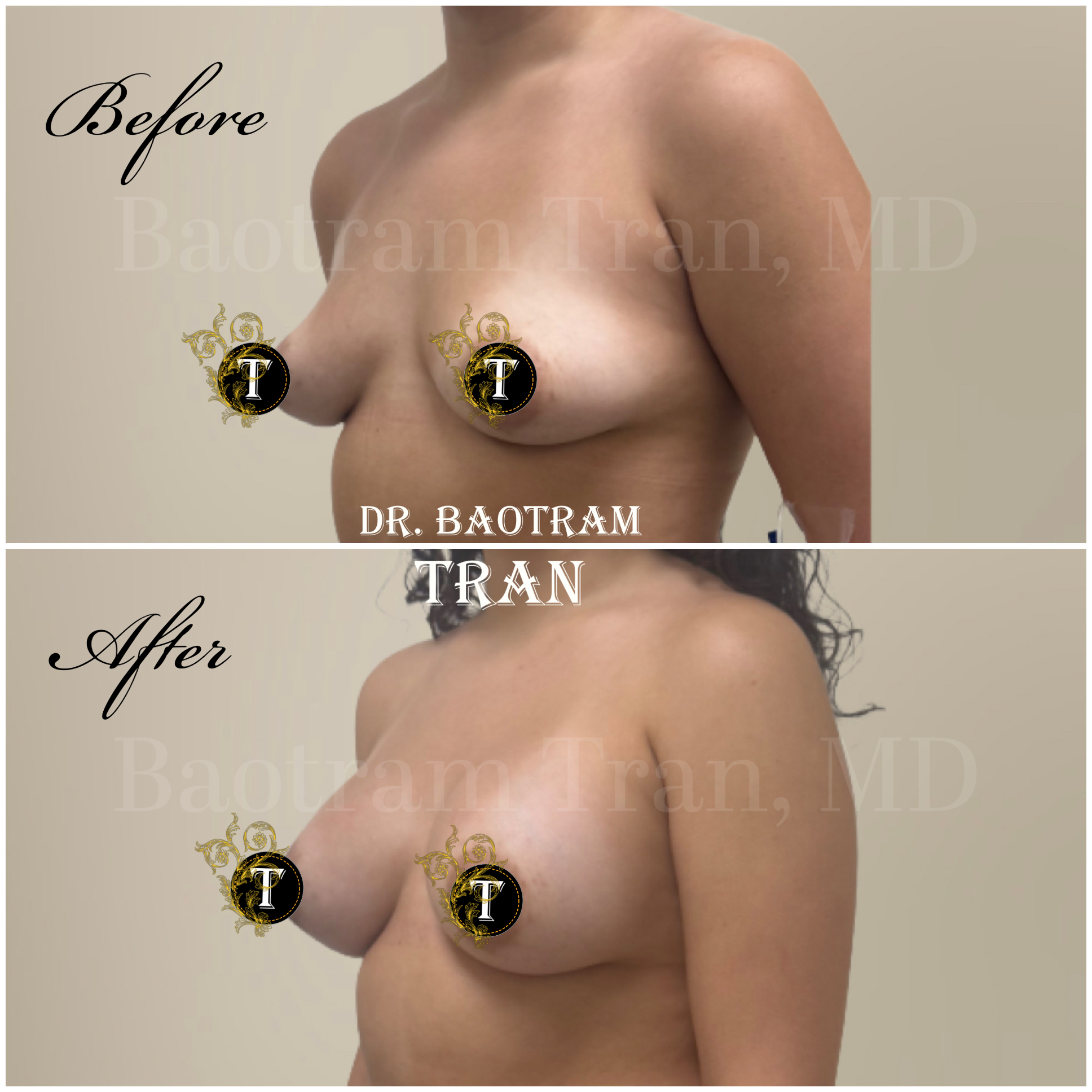 Before and After Image: Breast Augmentation - left-front-oblique