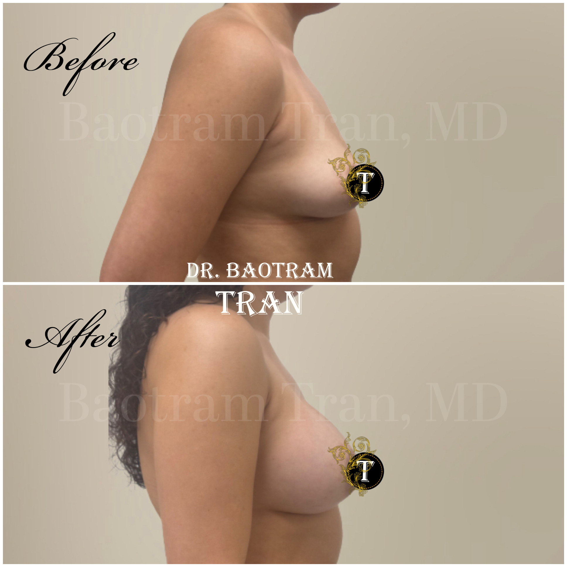 Before and After Image: Breast Augmentation - right-side
