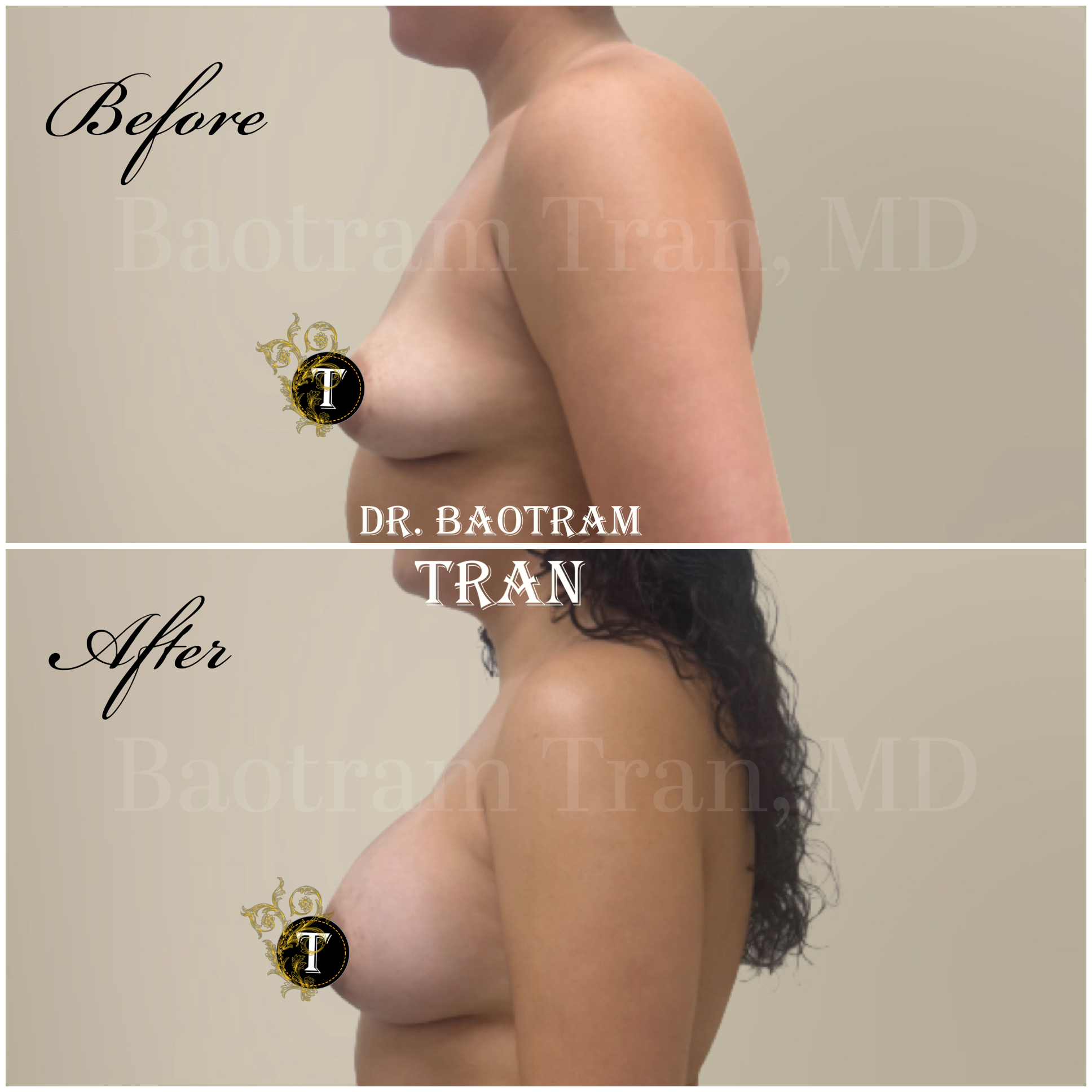 Before and After Image: Breast Augmentation - left-side