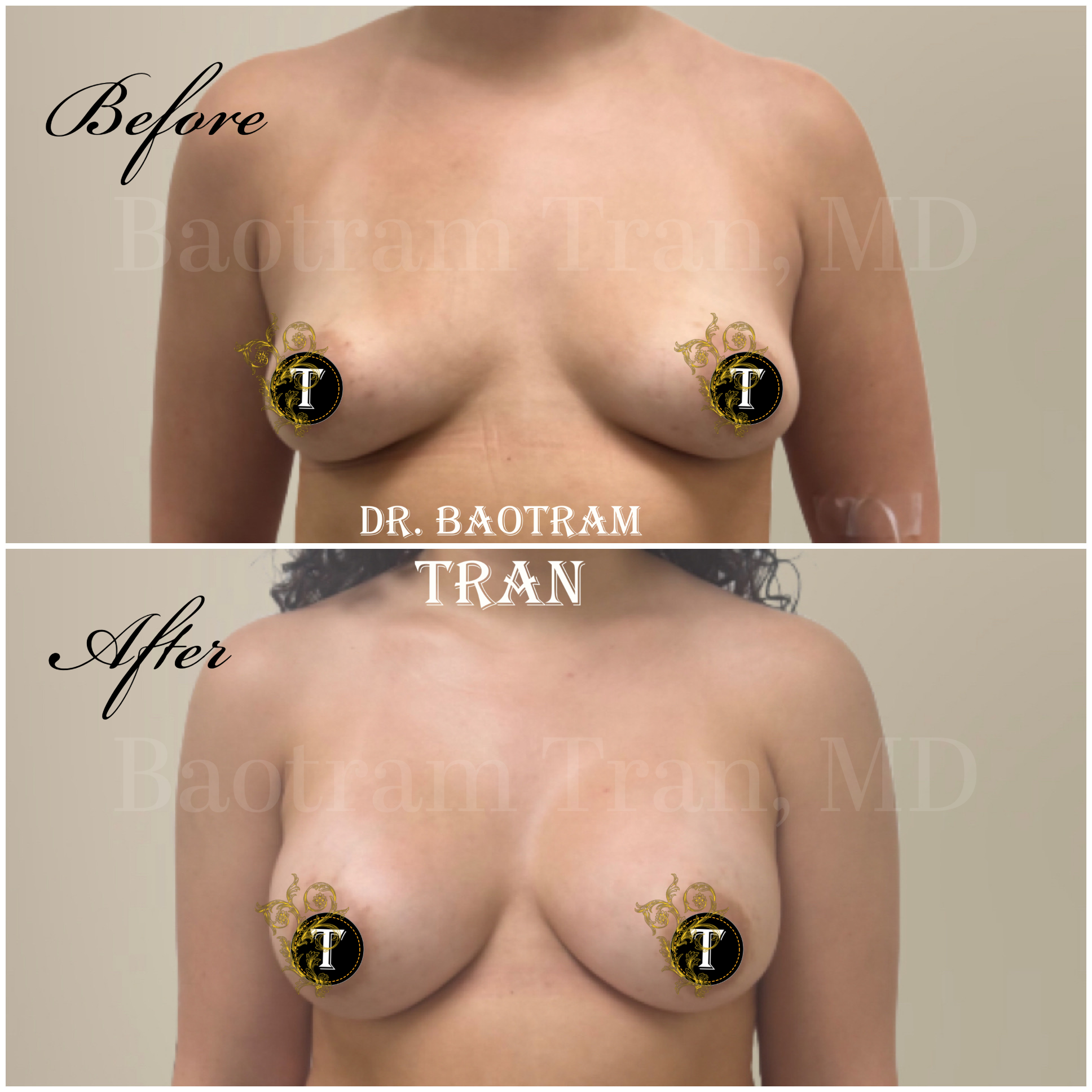 Before and After Image: Breast Augmentation - front