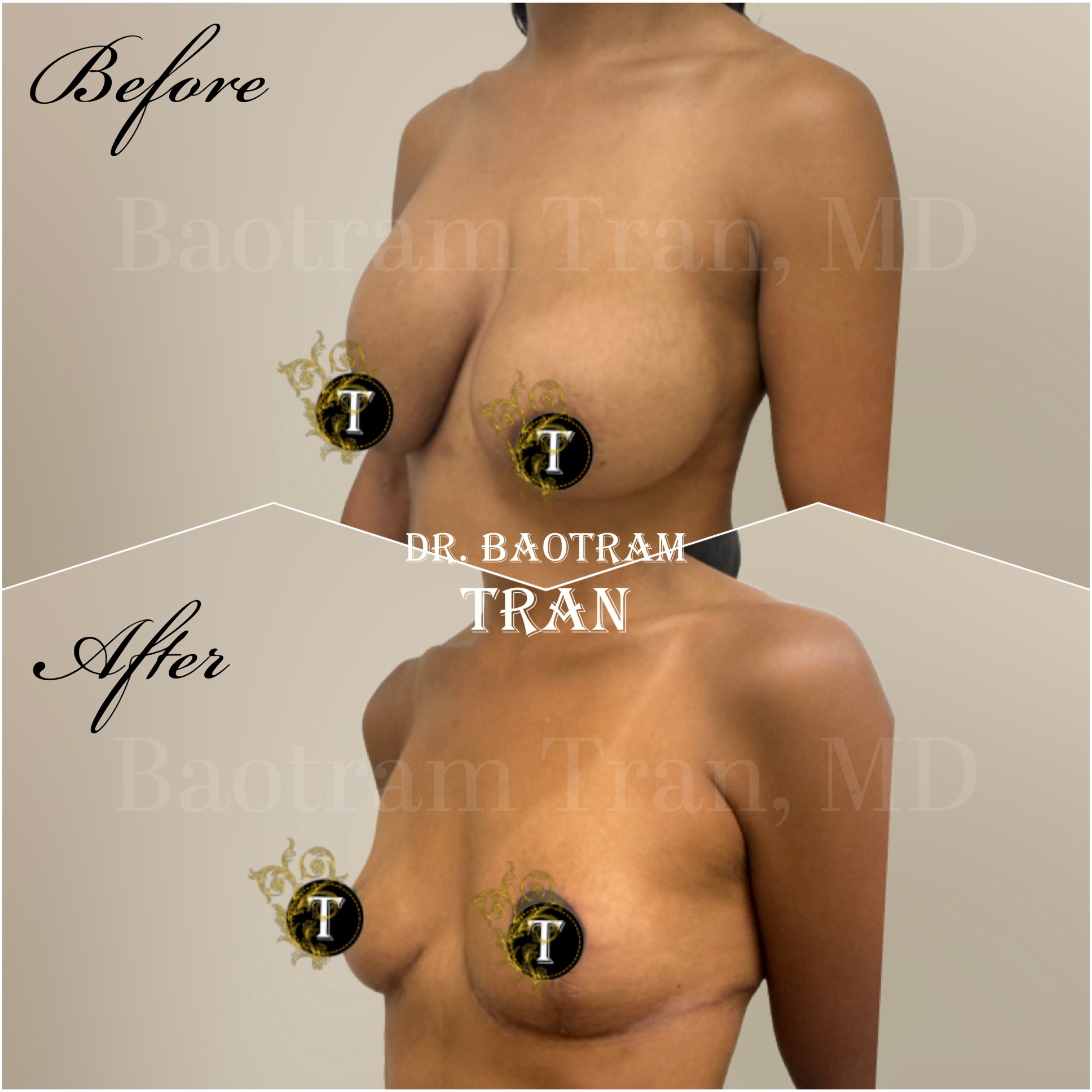 Before and After Image: Breast implant removal and breast lift - left-front-oblique