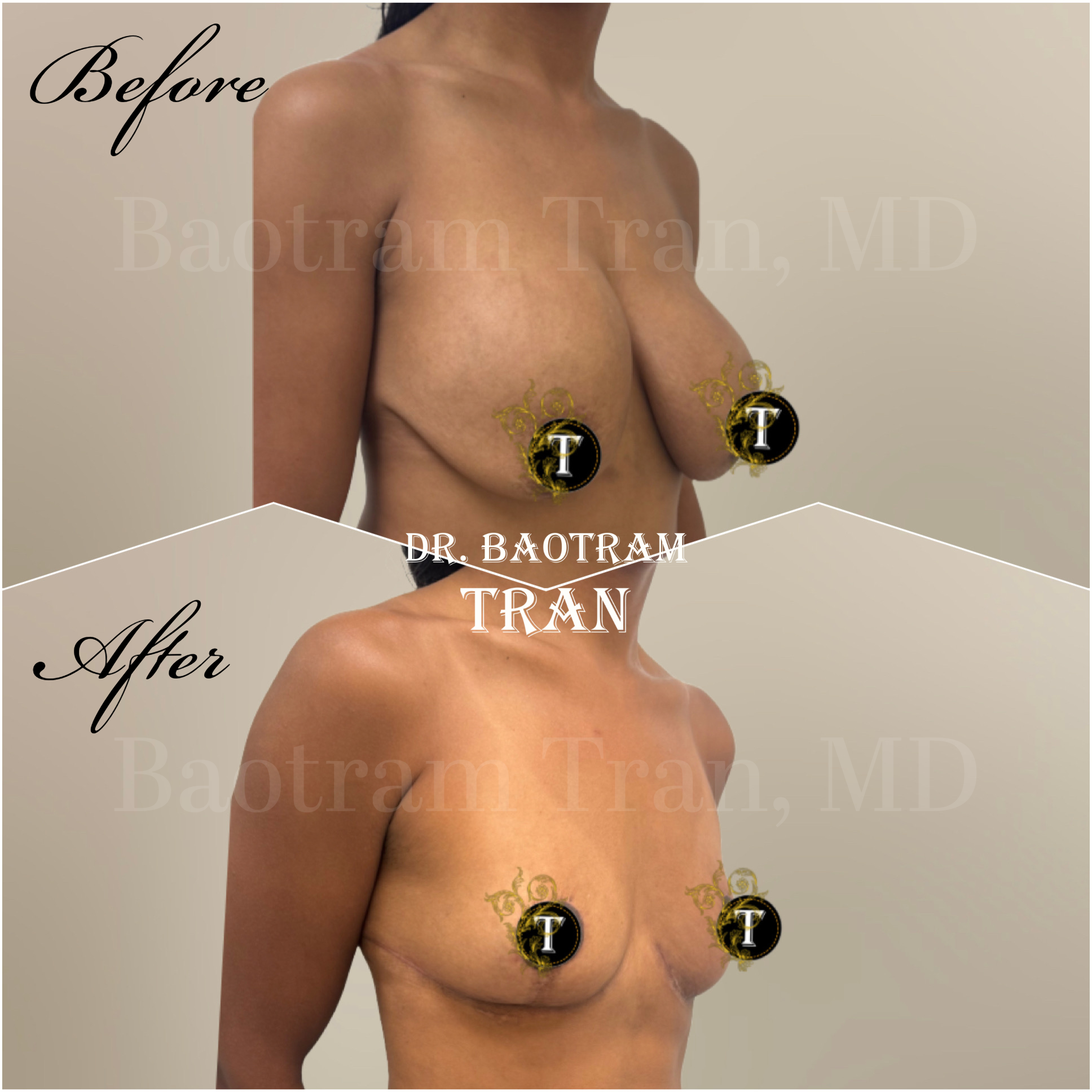 Before and After Image: Breast implant removal and breast lift - right-front-oblique