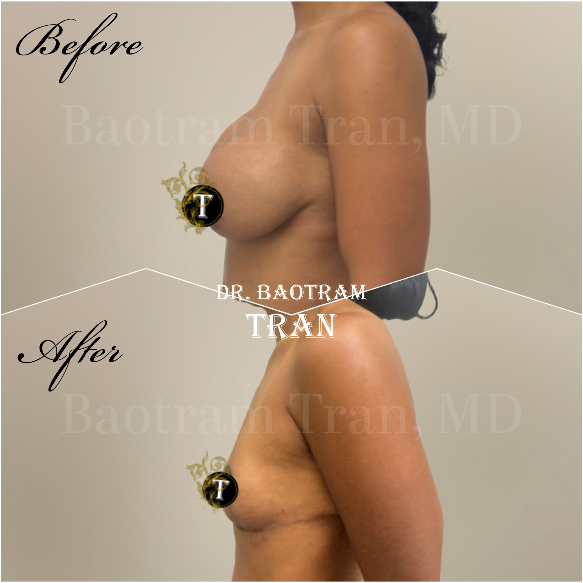 Before and After Image: Breast implant removal and breast lift - left-side