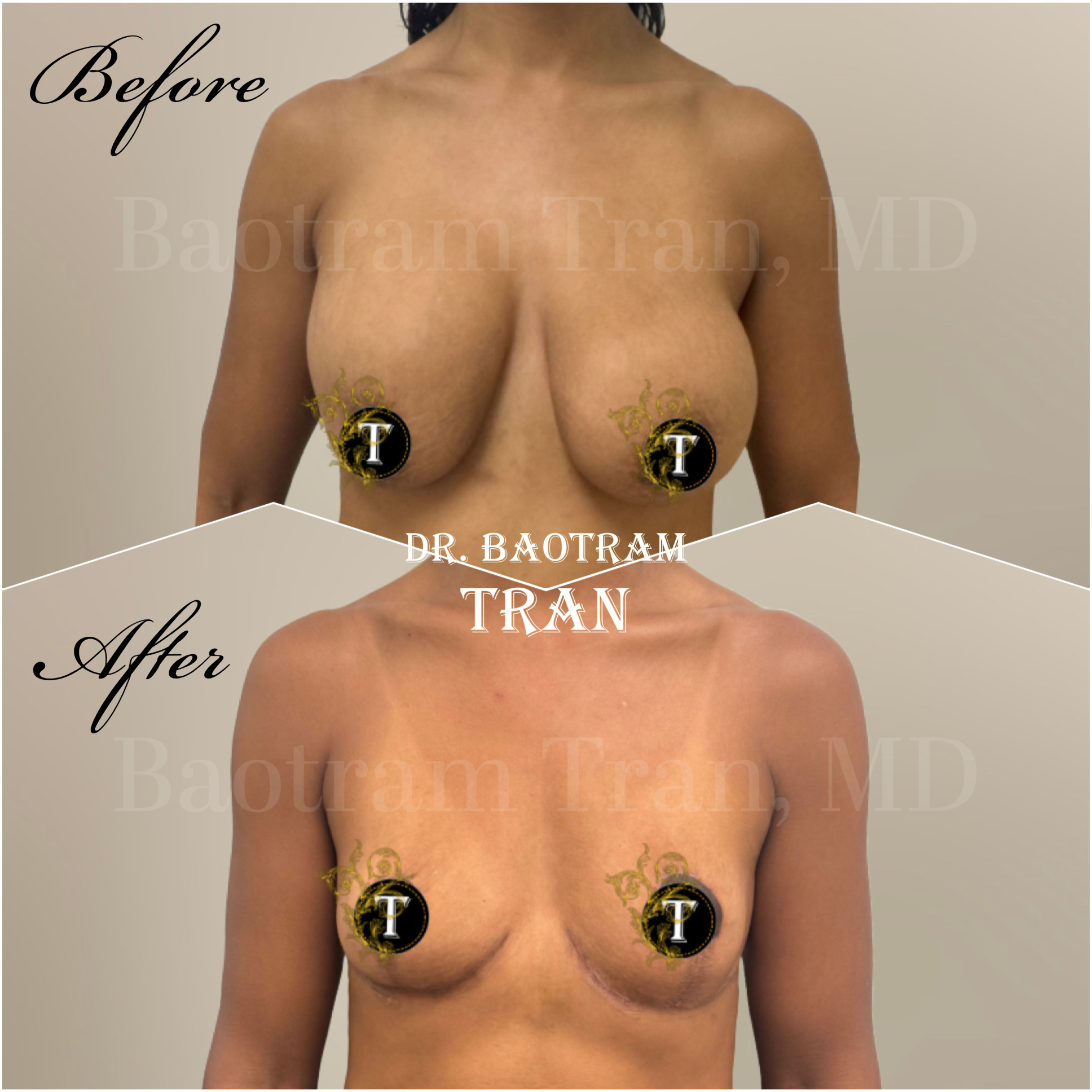 Before and After Image: Breast implant removal and breast lift - front