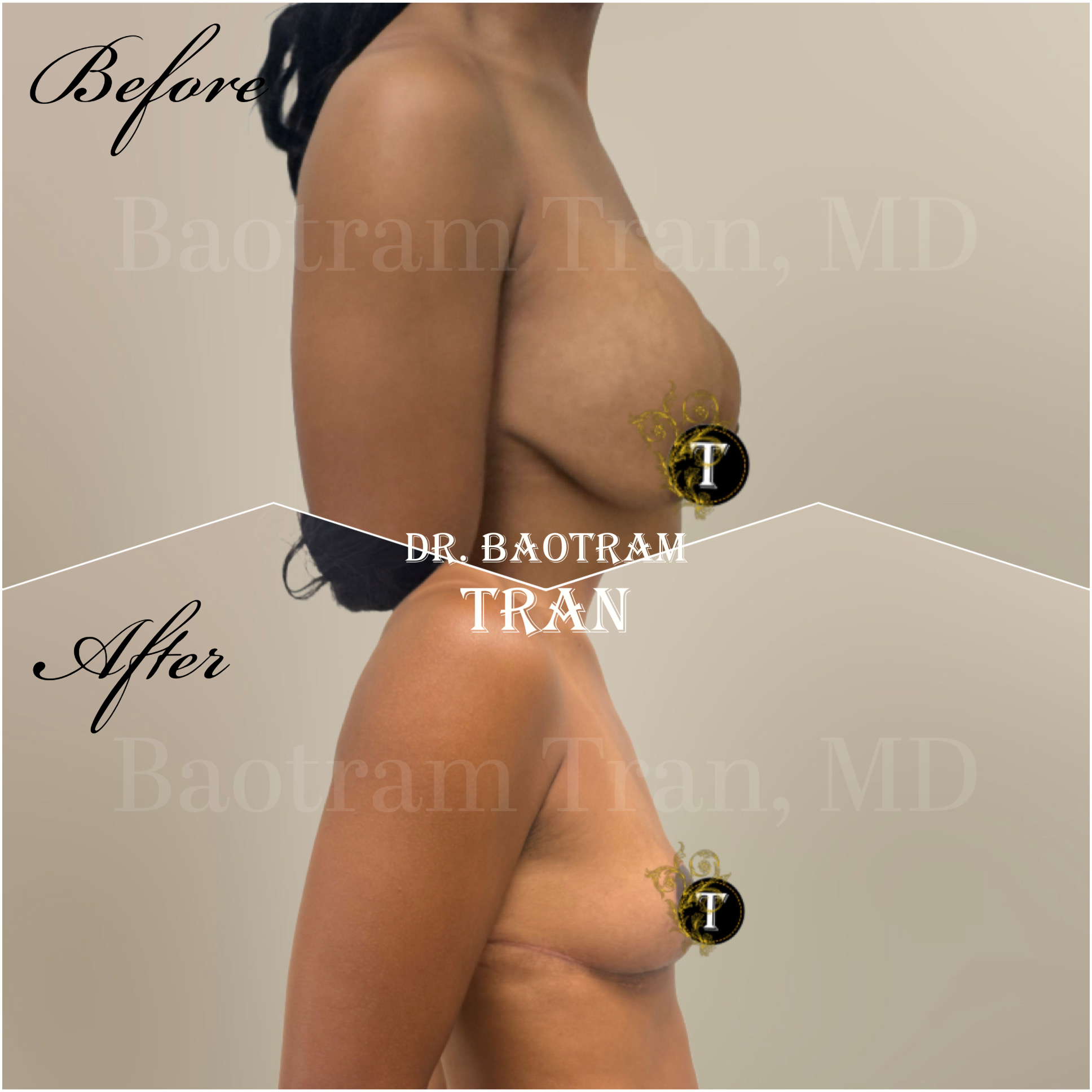 Before and After Image: Breast implant removal and breast lift - right-side