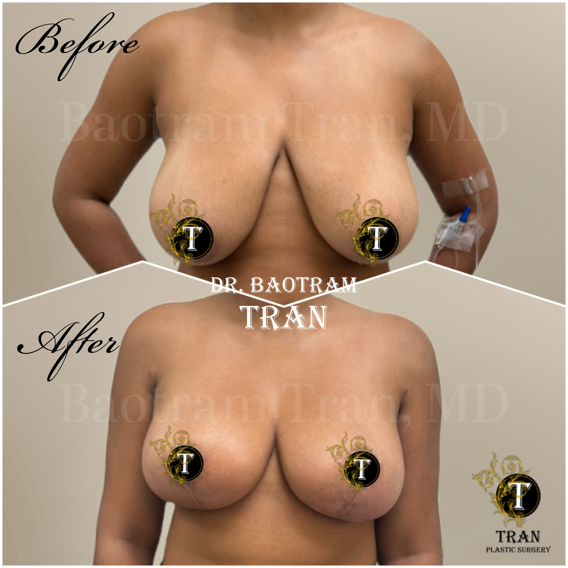 Before and After Image: Breast Reduction - front