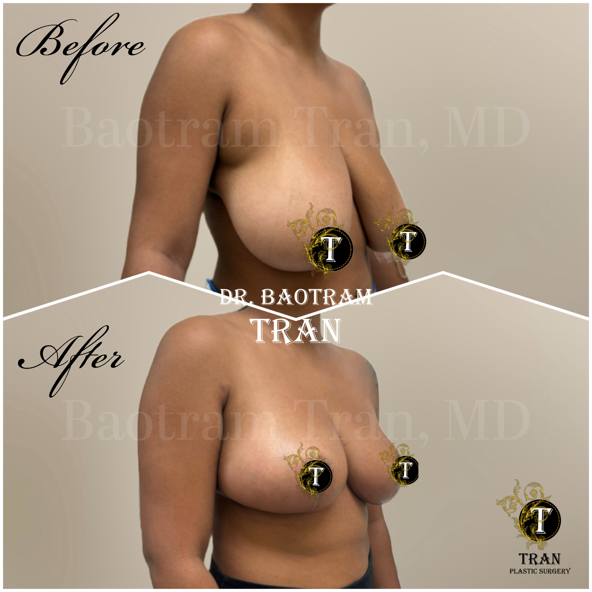 Before and After Image: Breast Reduction - right-front-oblique