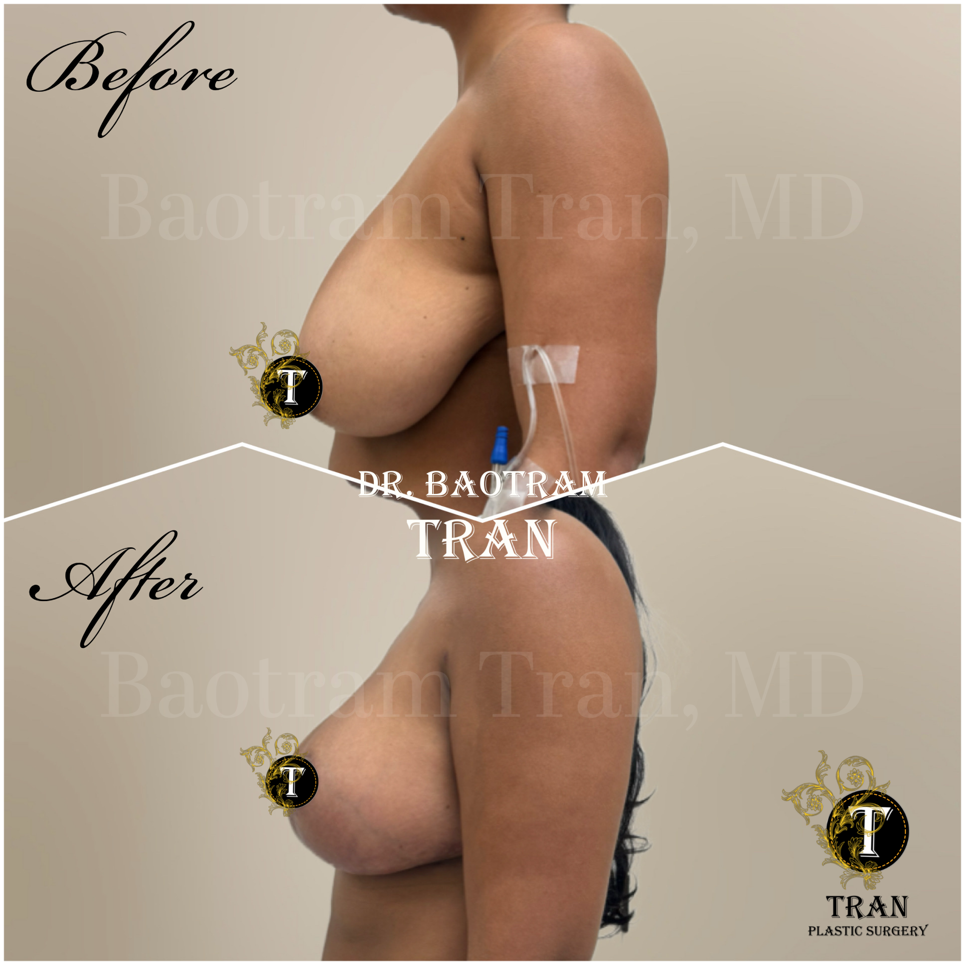 Before and After Image: Breast Reduction - left-side