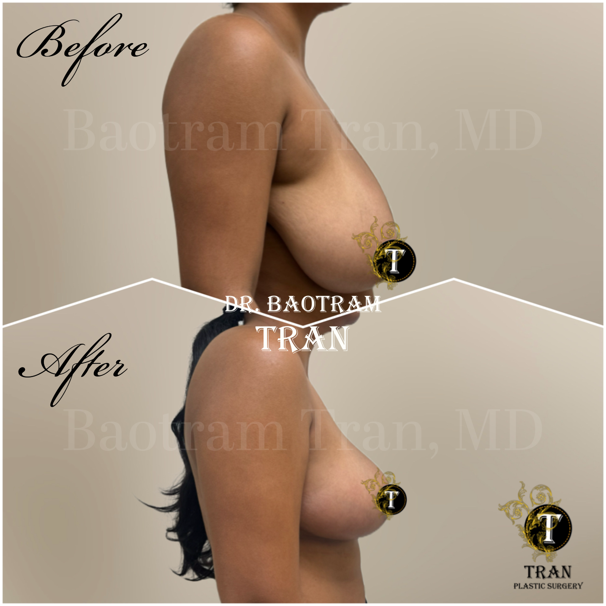 Before and After Image: Breast Reduction -